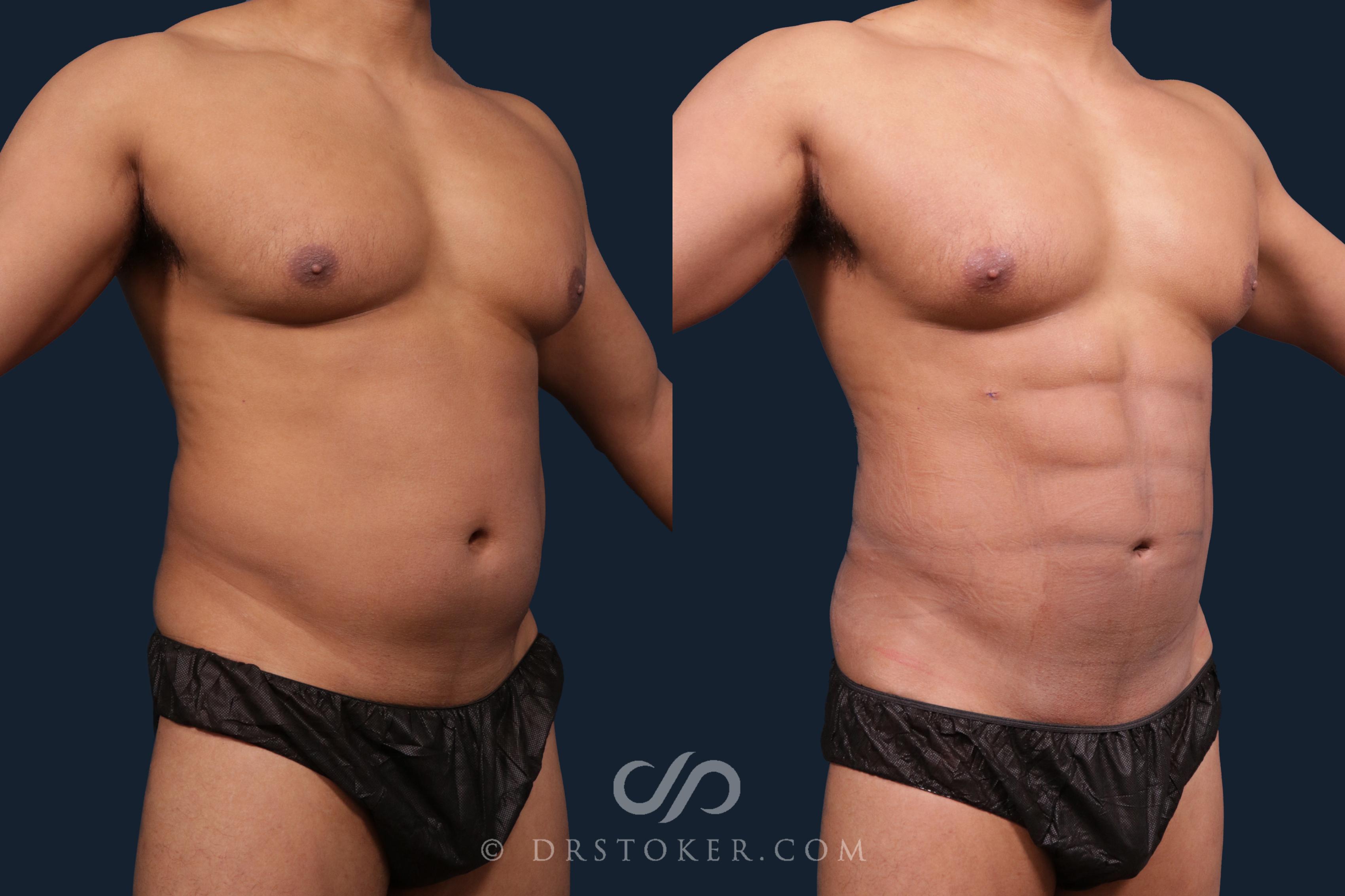 Abdominal Etching Sculpting For Men Before And After Pictures Case