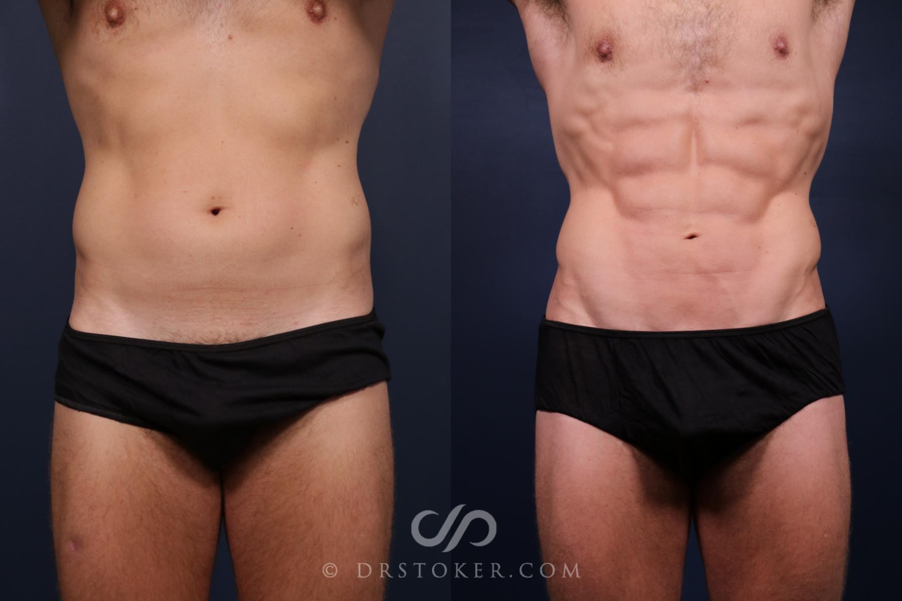 Before & After Abdominal Etching & Sculpting for Men Case 2659 Front View in Los Angeles, CA