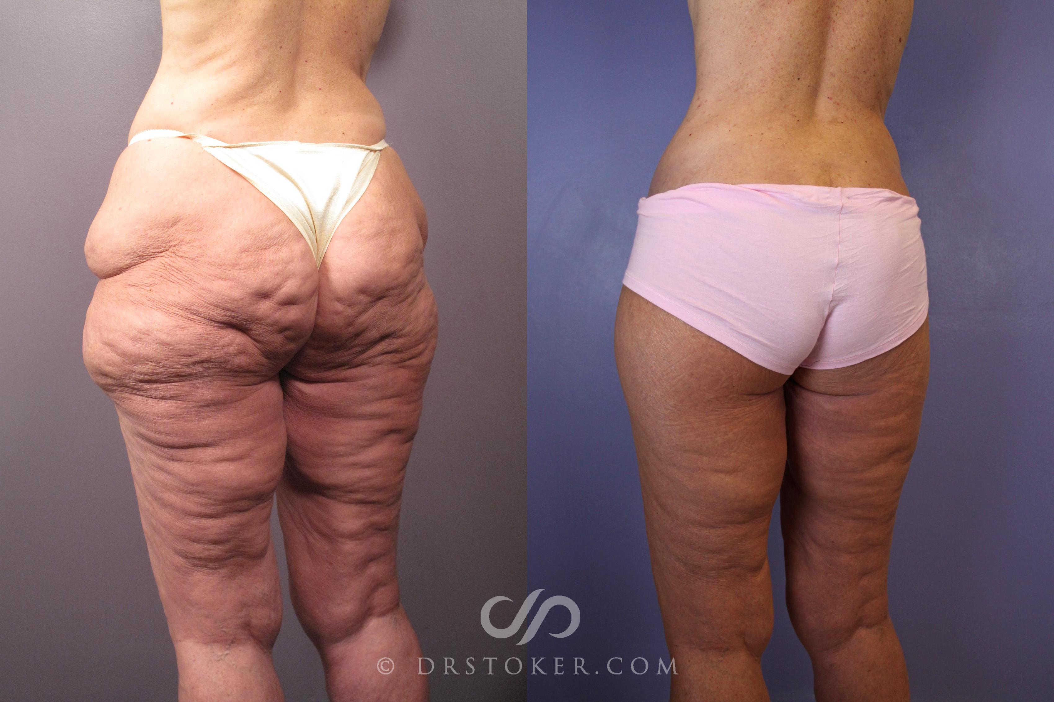 Before & After Body Lift Case 1008 View #1 View in Los Angeles, CA