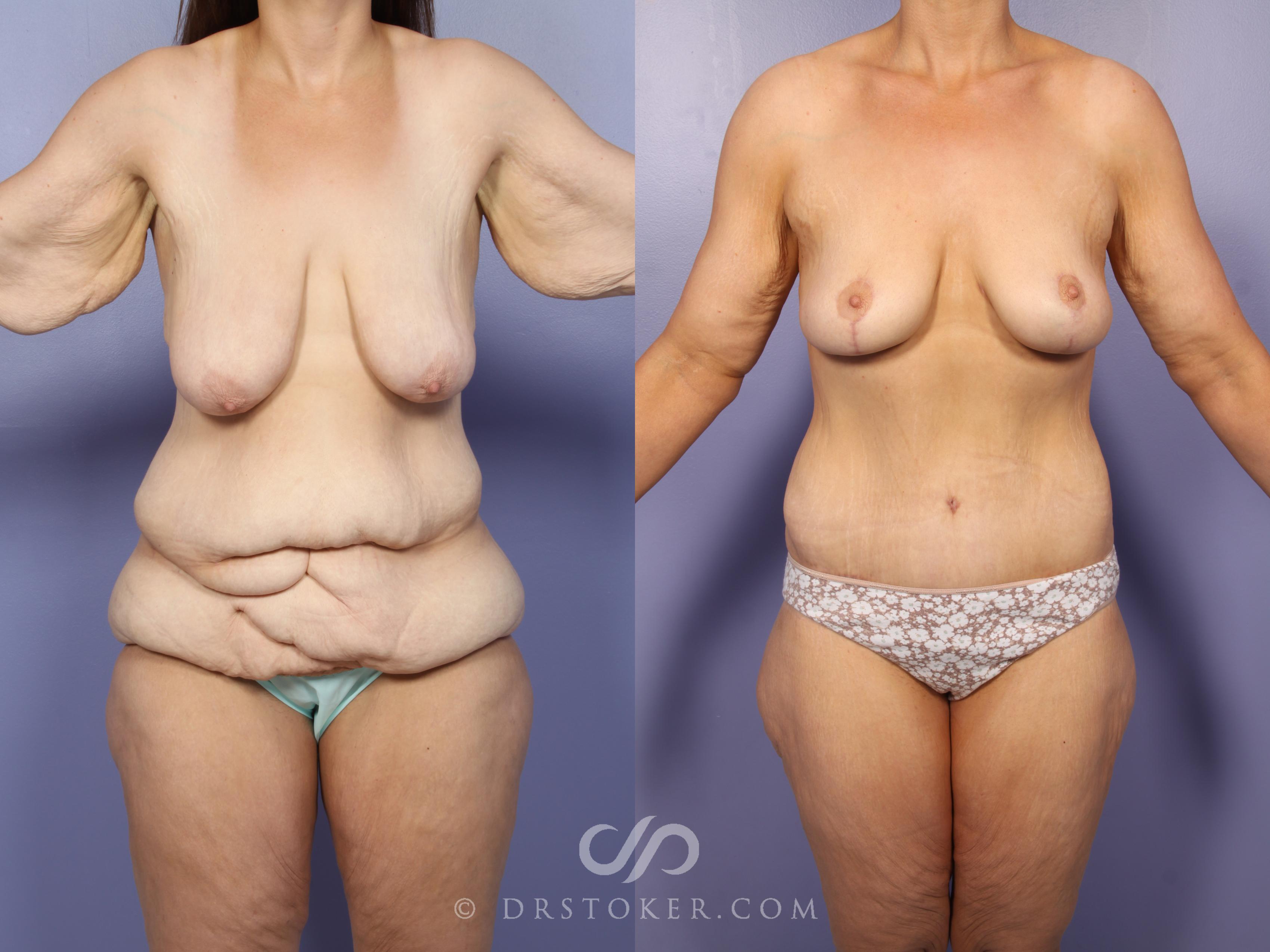 Before & After After Weight Loss Case 1658 View #1 View in Los Angeles, CA