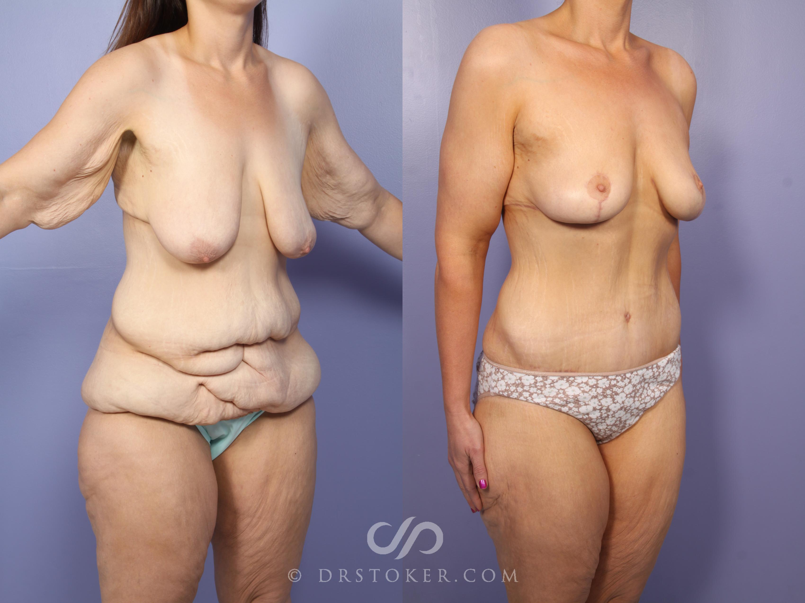 Before & After After Weight Loss Case 1659 View #1 View in Los Angeles, CA
