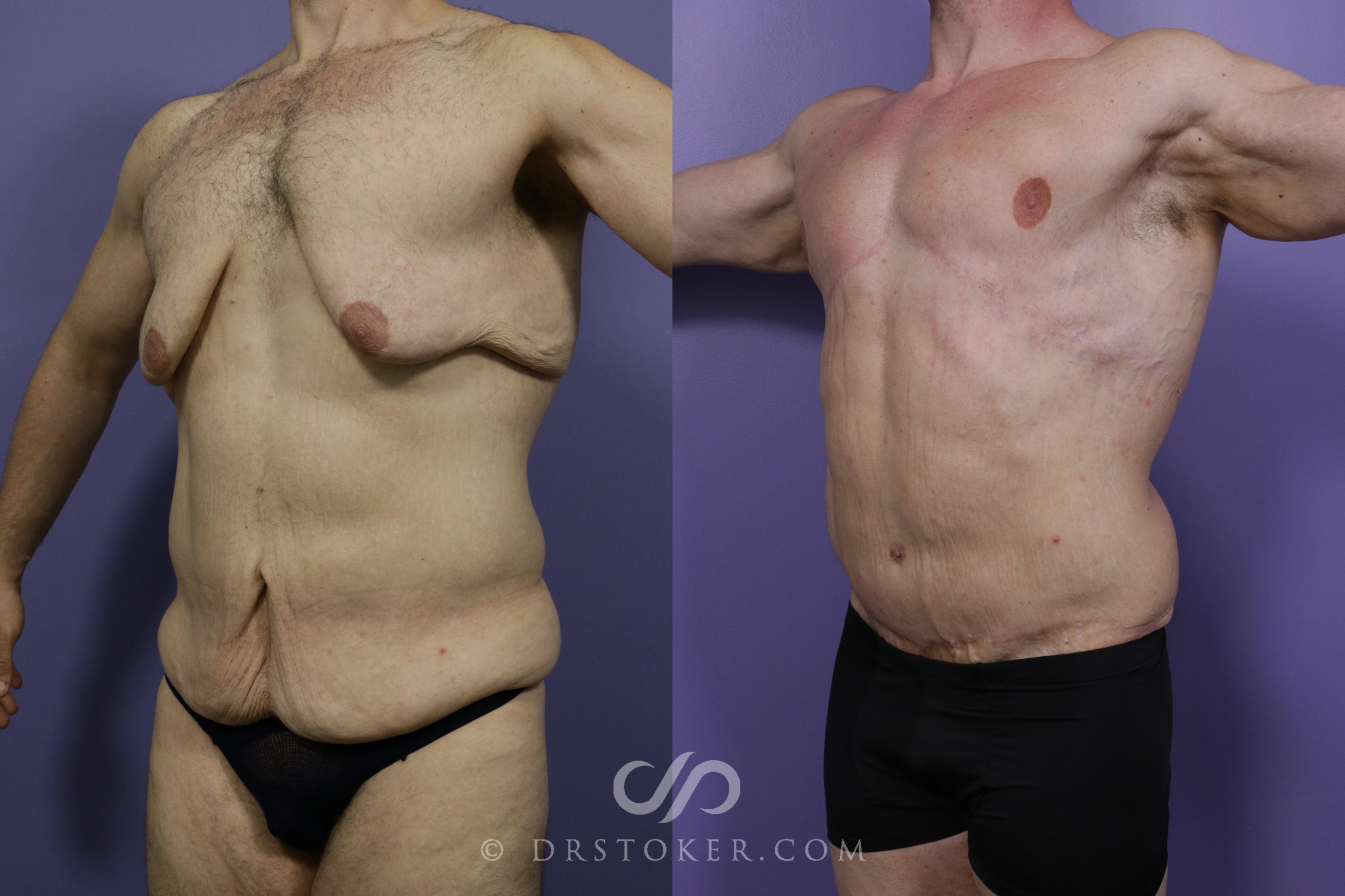 Before & After Body Lift Case 1716 View #1 View in Los Angeles, CA