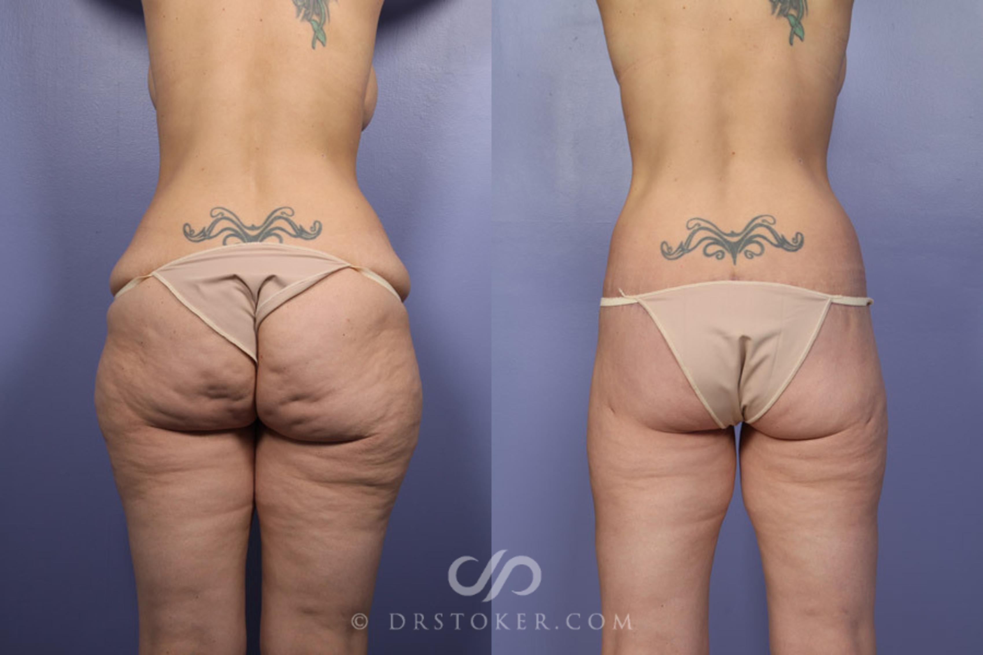 Before & After Posterior Lift Case 339 View #1 View in Los Angeles, CA