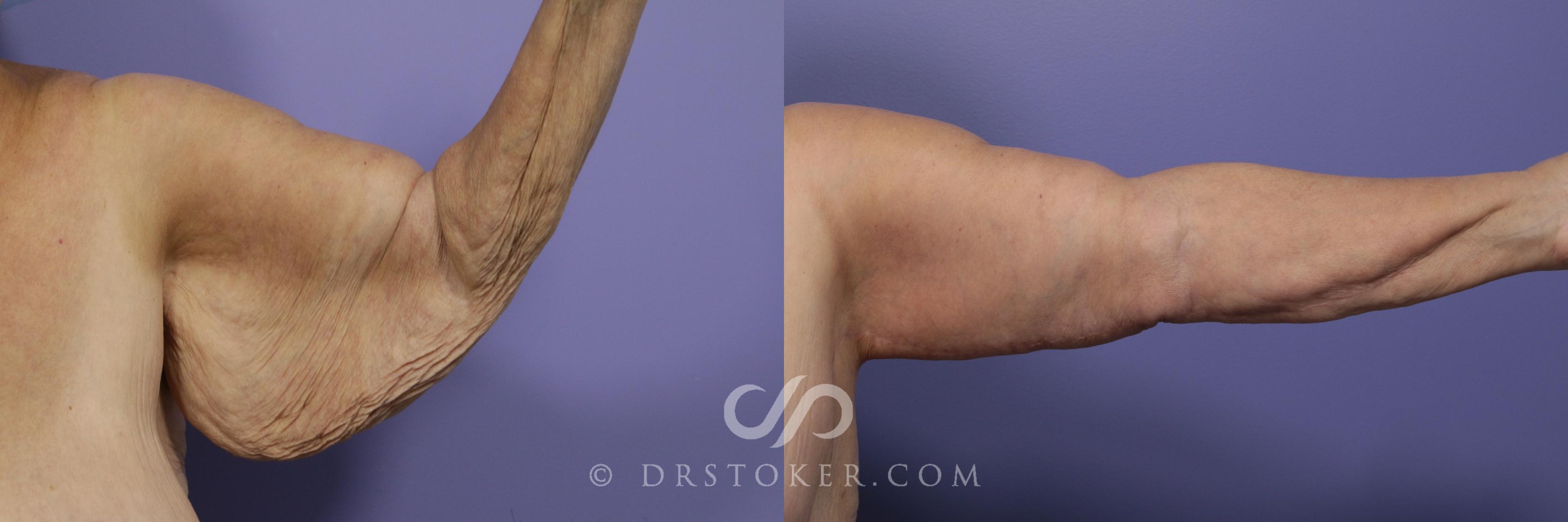 Before & After Arm Lift Case 1152 View #1 View in Los Angeles, CA