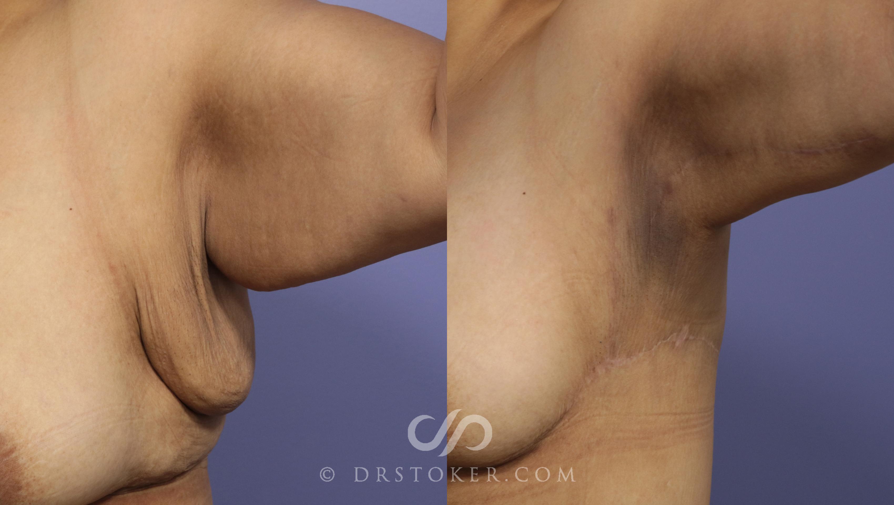 Before & After Arm Lift Case 693 View #1 View in Los Angeles, CA