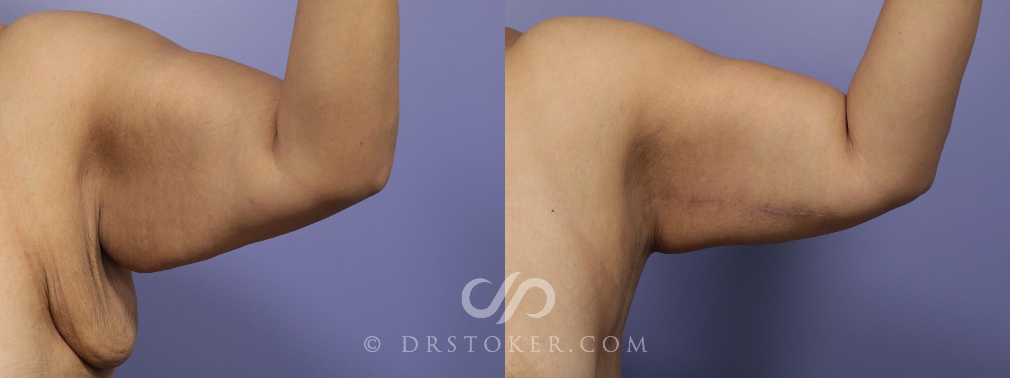 Before & After Arm Lift Case 696 View #1 View in Los Angeles, CA