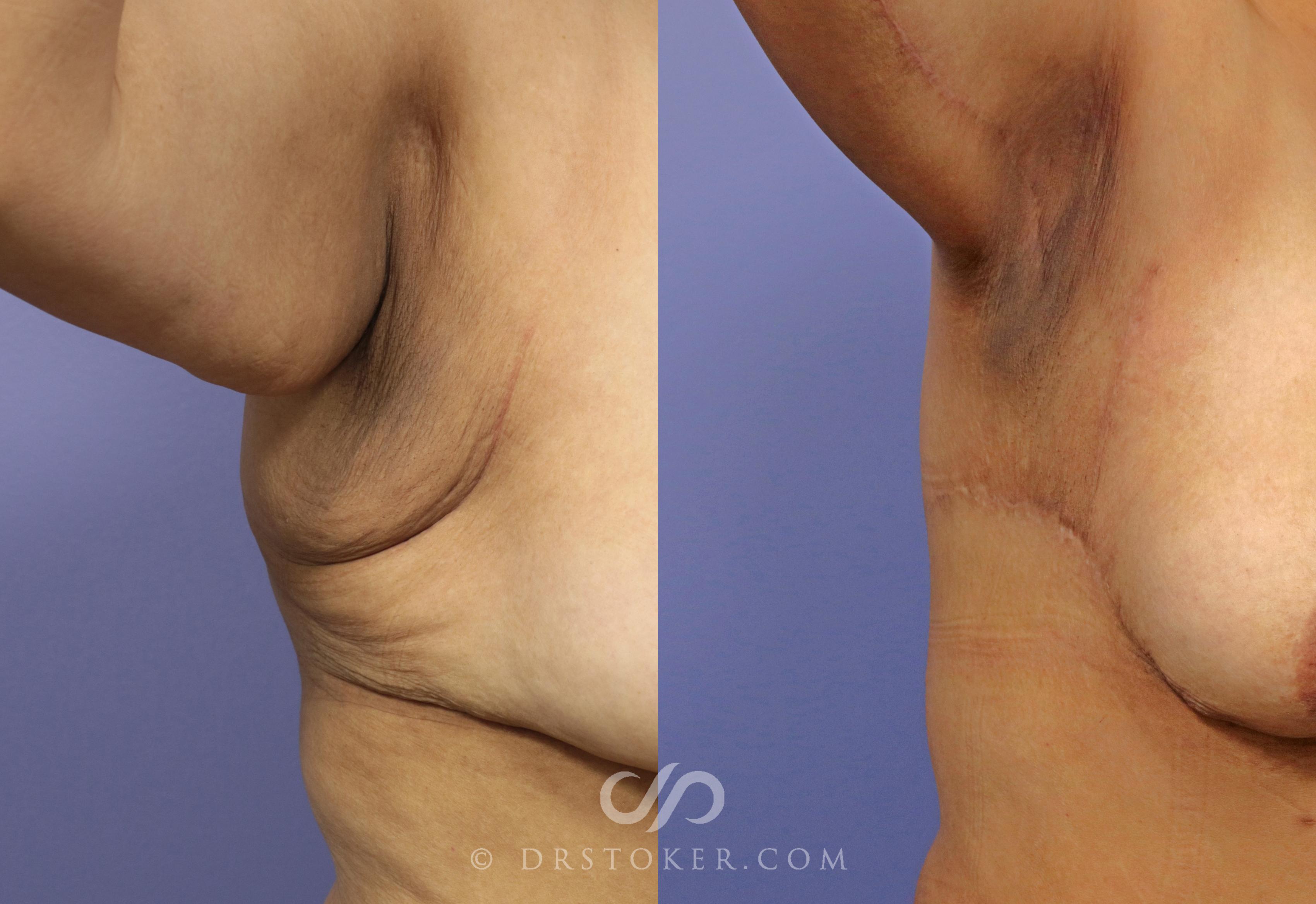 Before & After Arm Lift Case 697 View #1 View in Los Angeles, CA