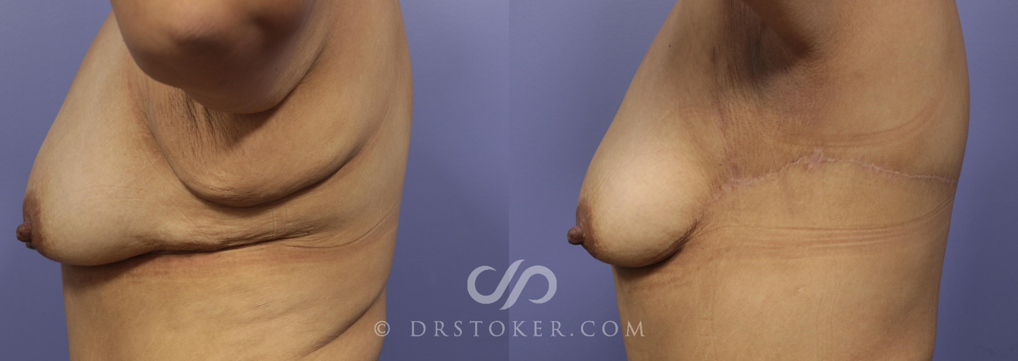 Before & After Back Lift (Bra Line Back Lift) Case 1092 View #1 View in Los Angeles, CA