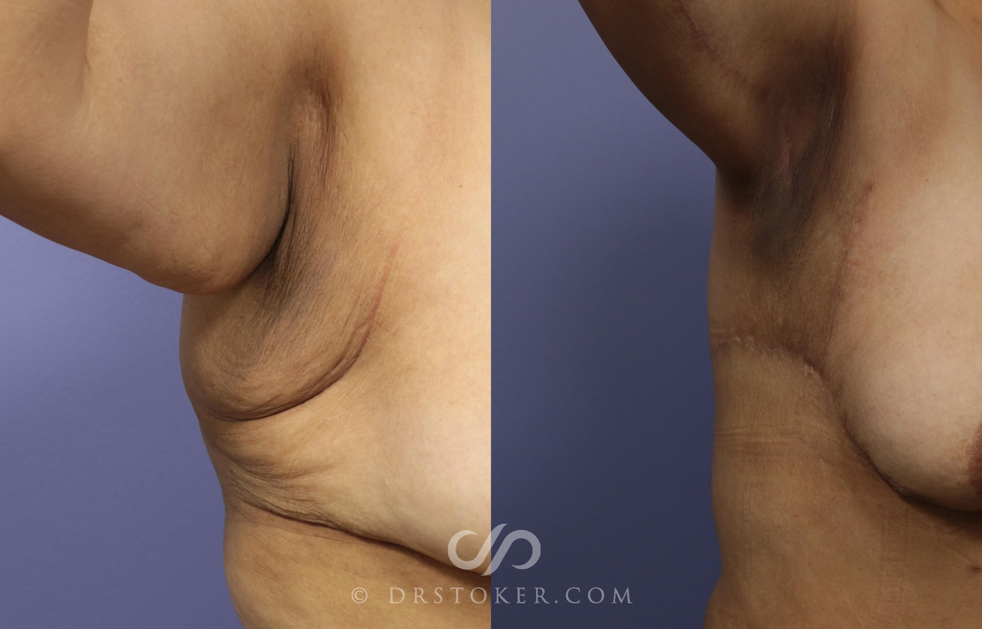 Before & After Back Lift (Bra Line Back Lift) Case 1094 View #1 View in Los Angeles, CA