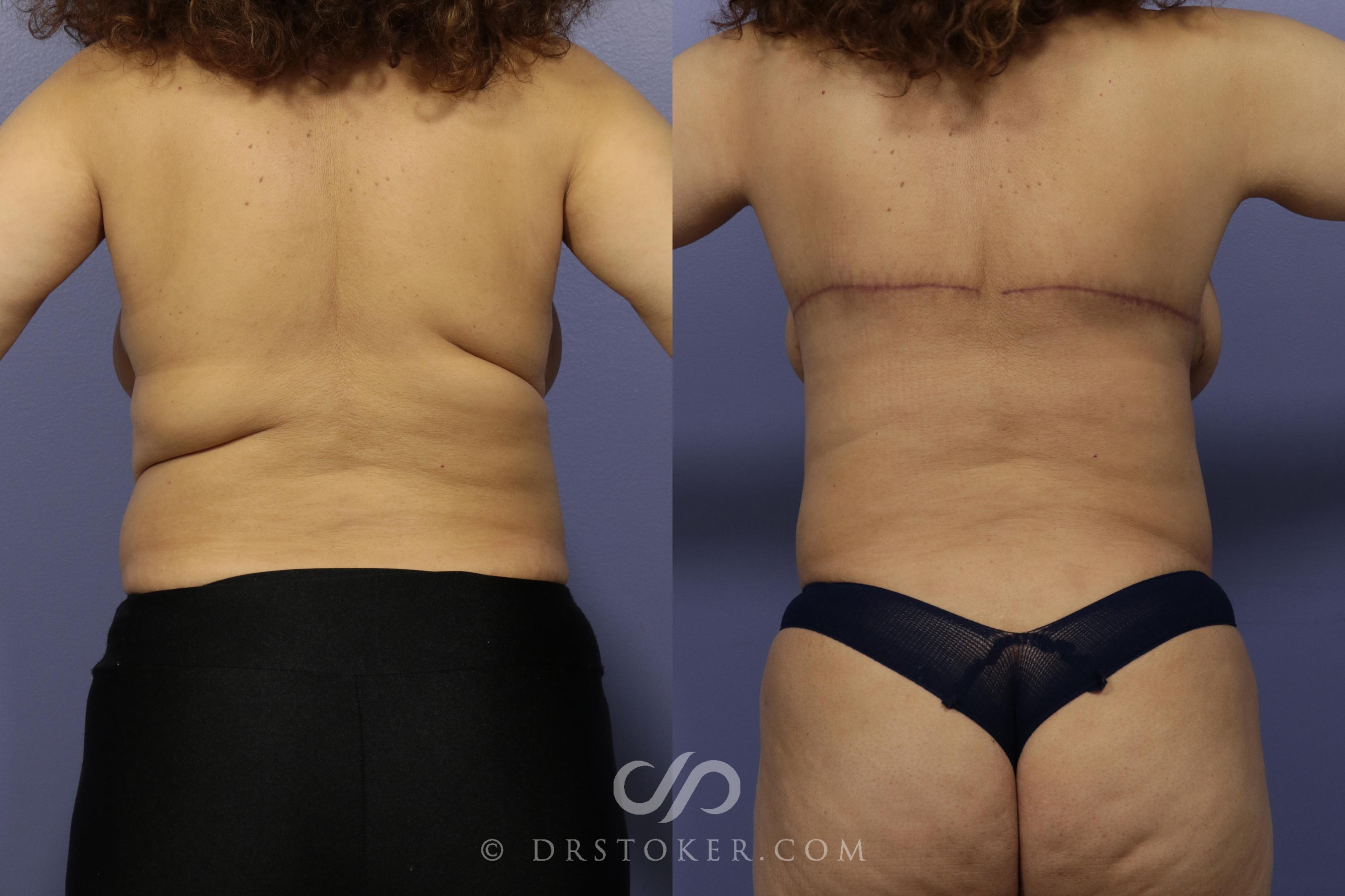 Before & After Back Lift (Bra Line Back Lift) Case 1100 View #1 View in Los Angeles, CA