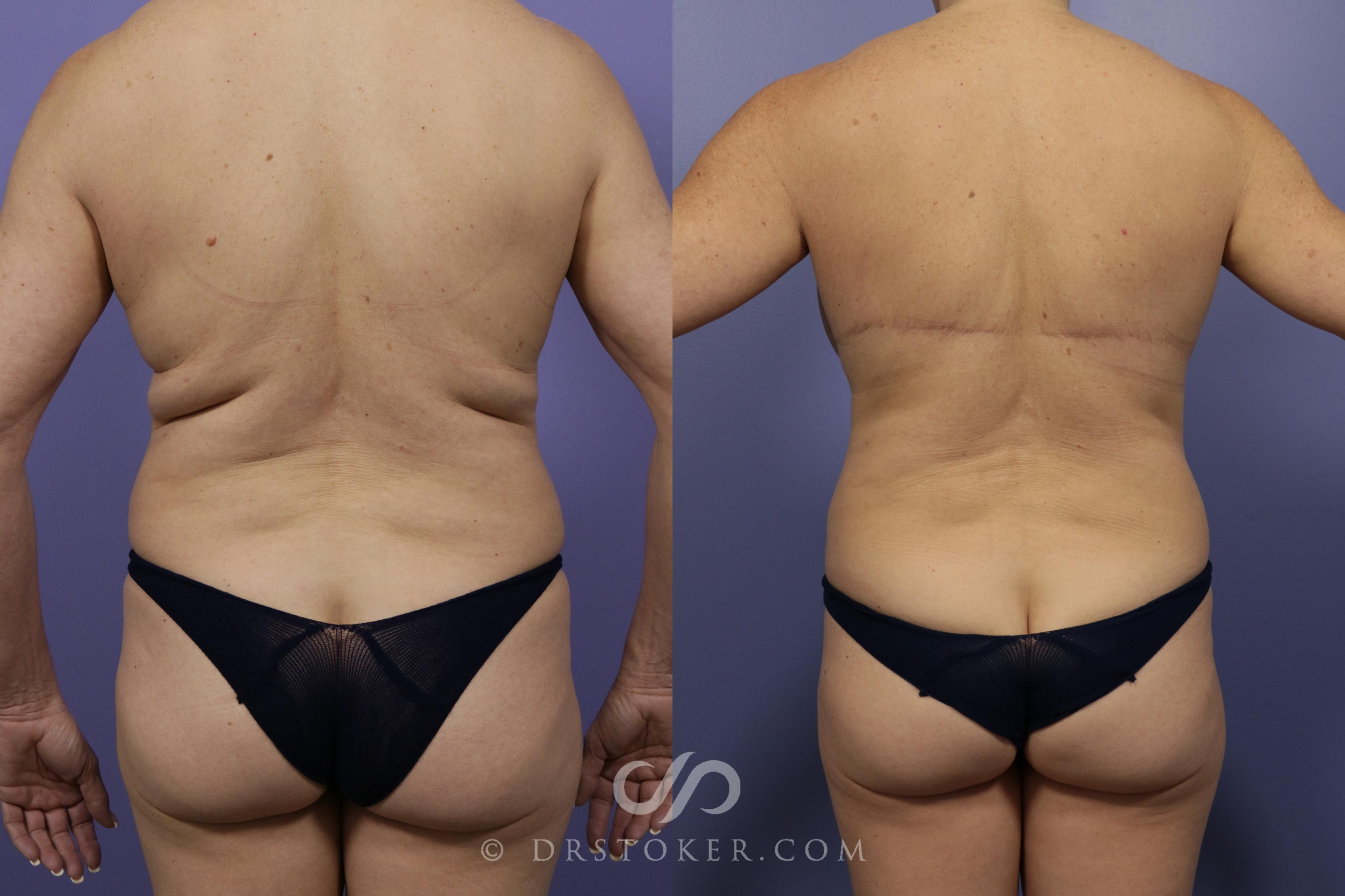 Before & After Back Lift (Bra Line Back Lift) Case 1103 View #1 View in Los Angeles, CA