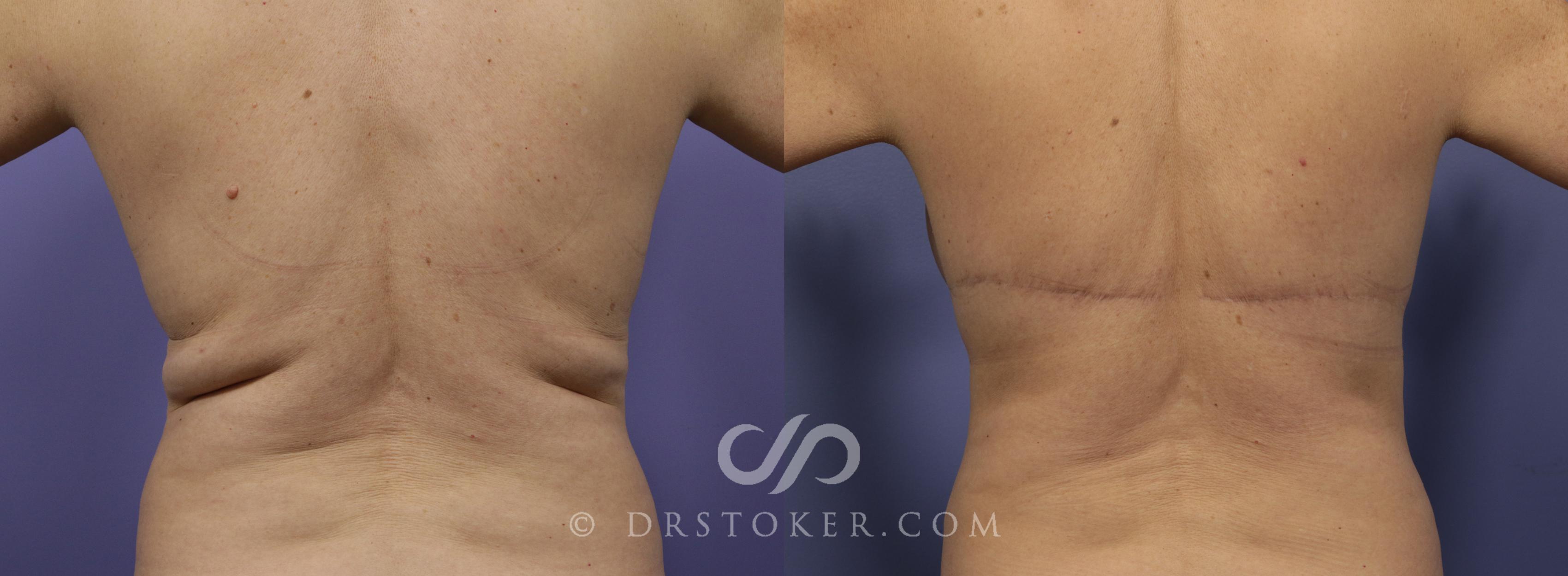 Before & After Back Lift (Bra Line Back Lift) Case 1104 View #1 View in Los Angeles, CA