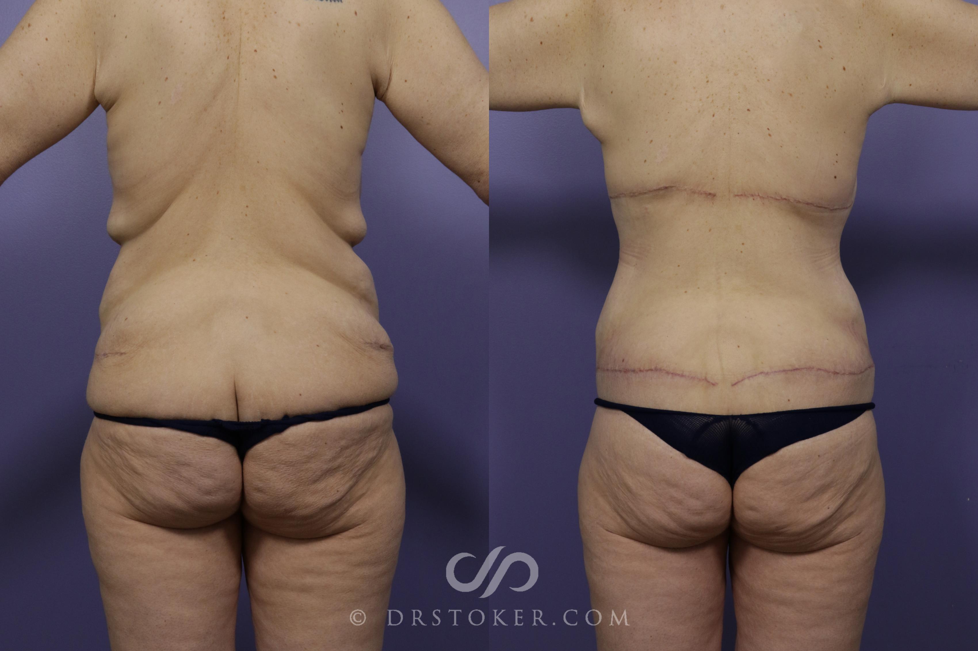 Before & After Back Lift (Bra Line Back Lift) Case 1254 View #1 View in Los Angeles, CA