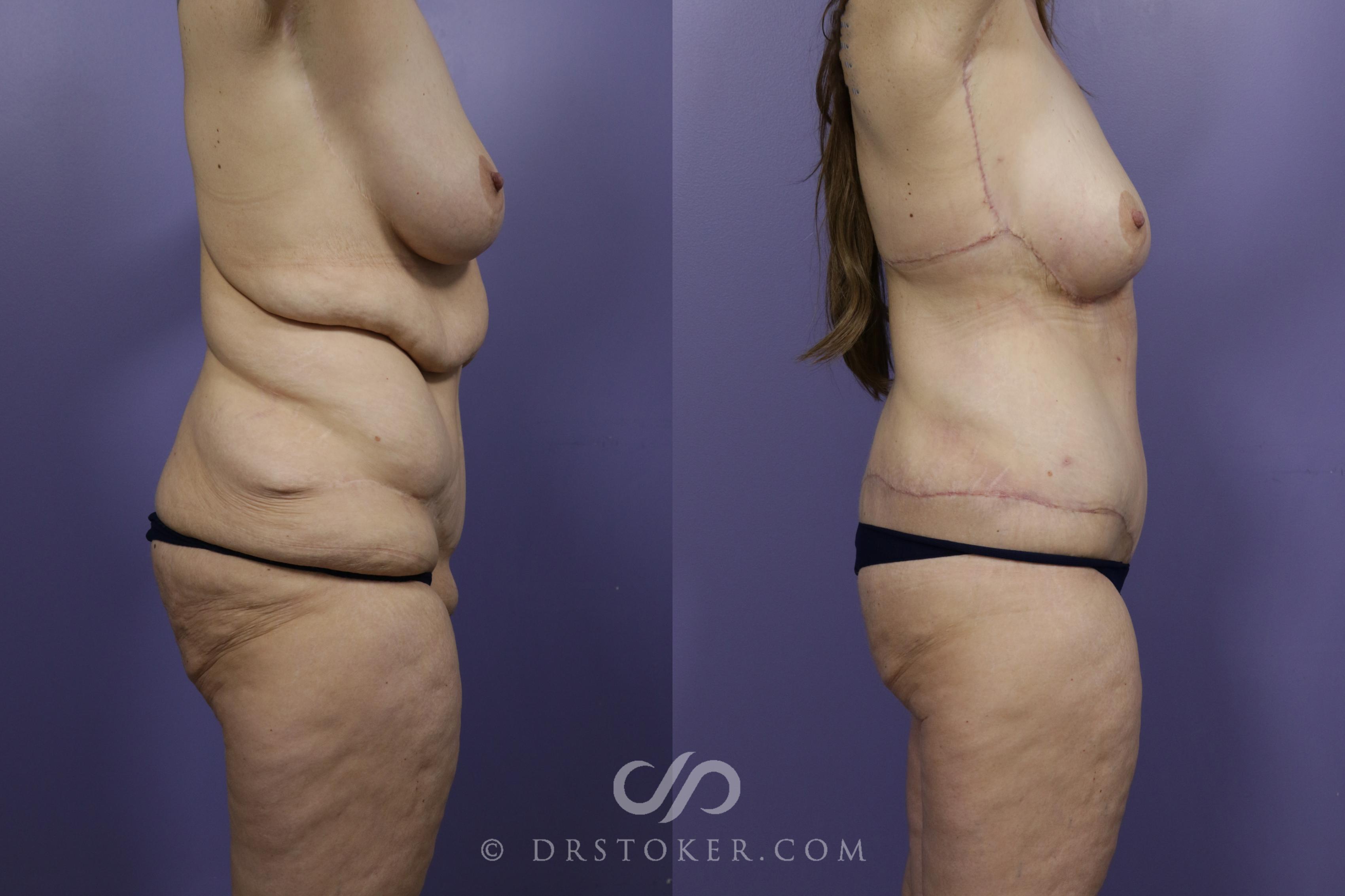 Before & After Back Lift (Bra Line Back Lift) Case 1255 View #1 View in Los Angeles, CA