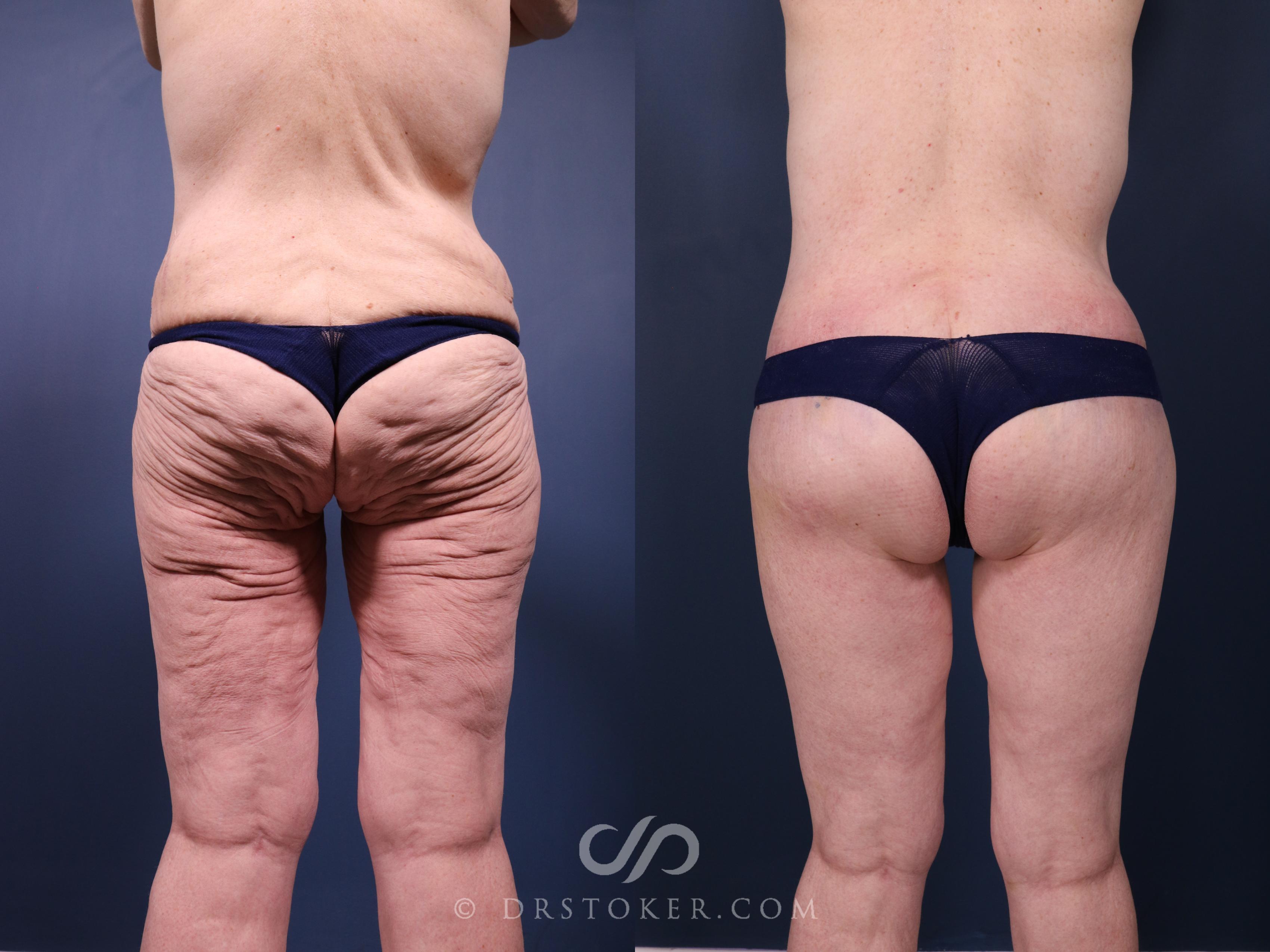 Before & After Bikini Body Lift ™ Case 2415 Back View in Los Angeles, CA
