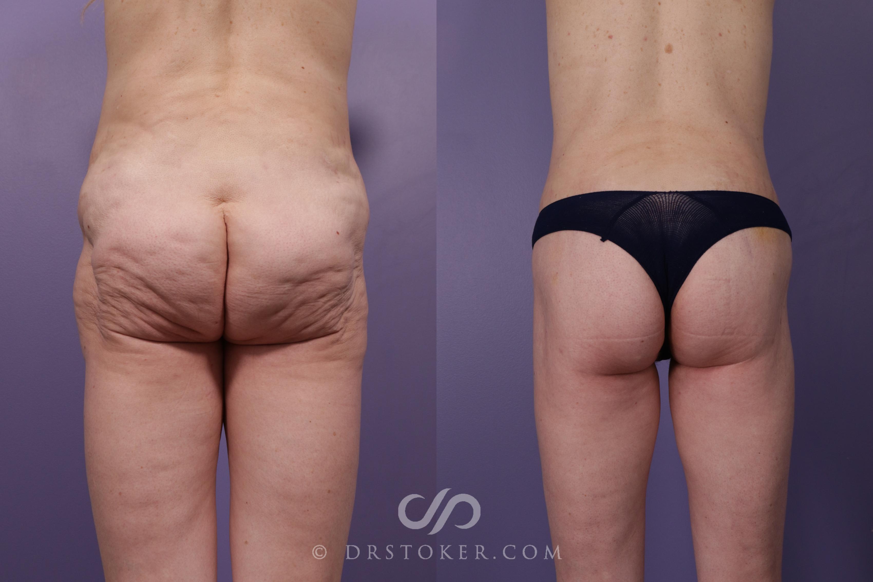 Before & After Bikini Body Lift ™ Case 2416 Back View in Los Angeles, CA