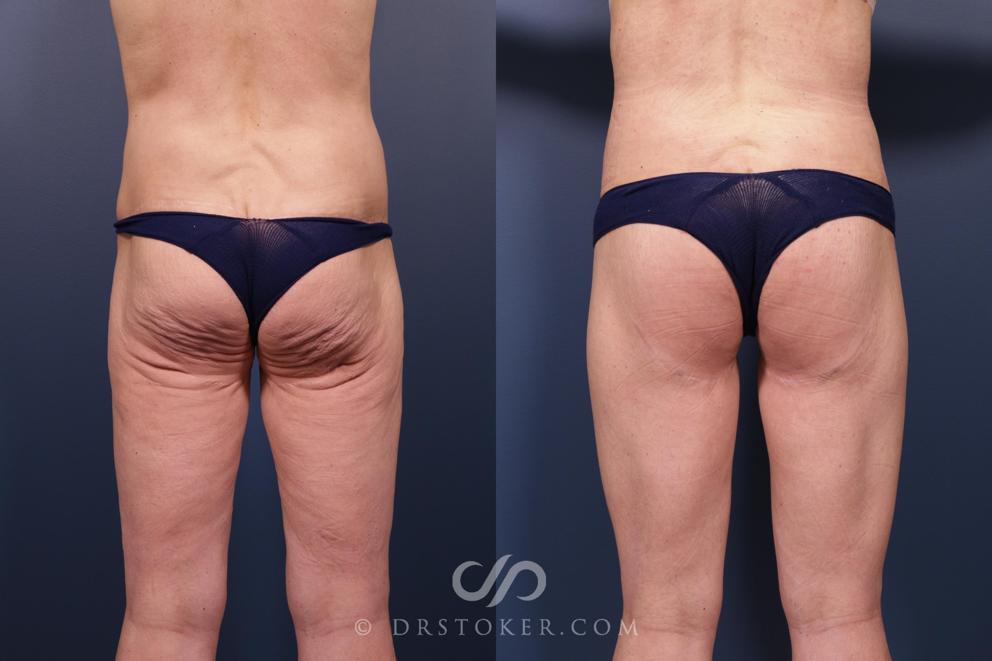 Before & After Bikini Body Lift ™ Case 2417 Back View in Los Angeles, CA