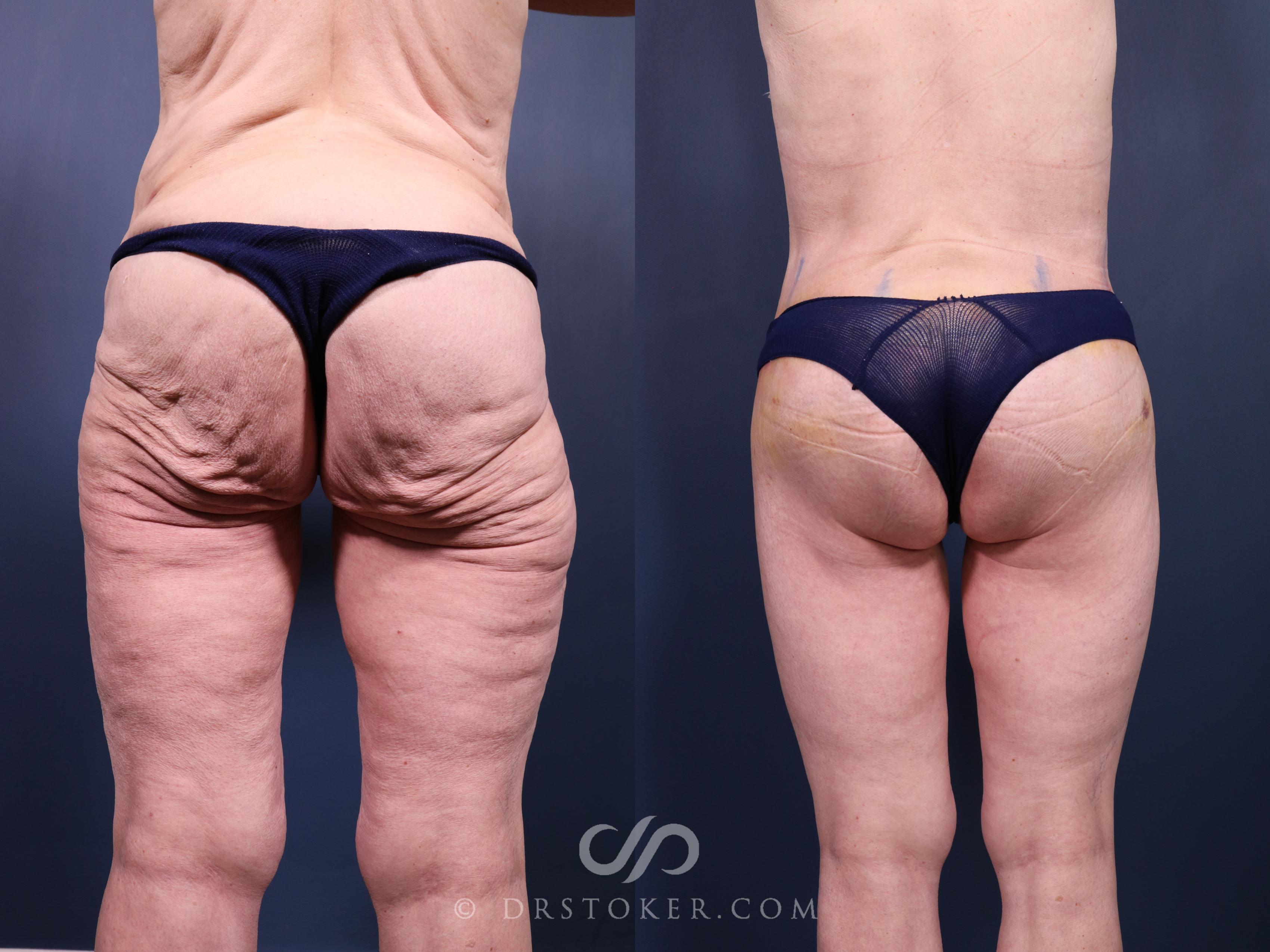Before & After Bikini Body Lift ™ Case 2418 Back View in Los Angeles, CA