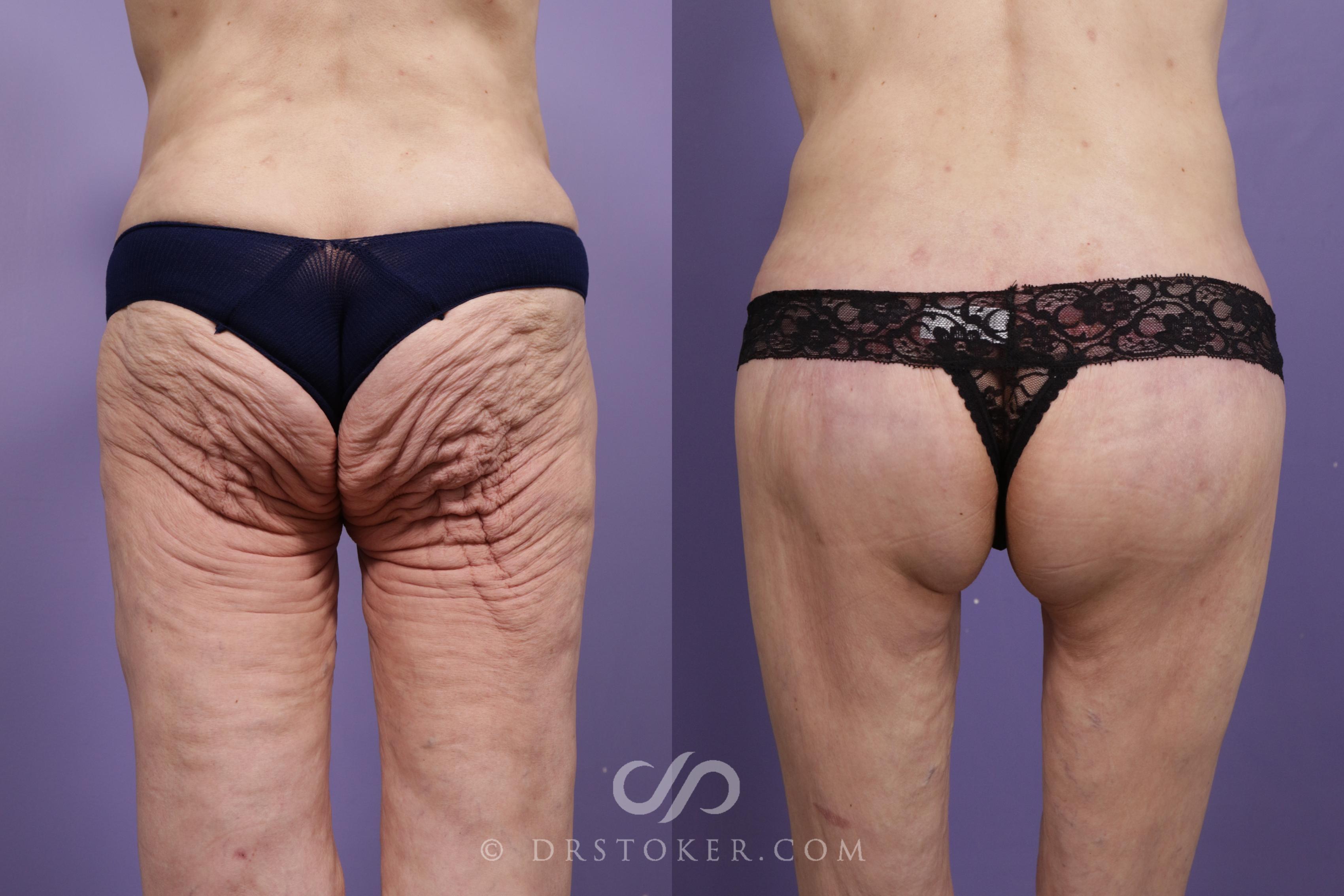 Before & After Bikini Body Lift ™ Case 2419 Back View in Los Angeles, CA