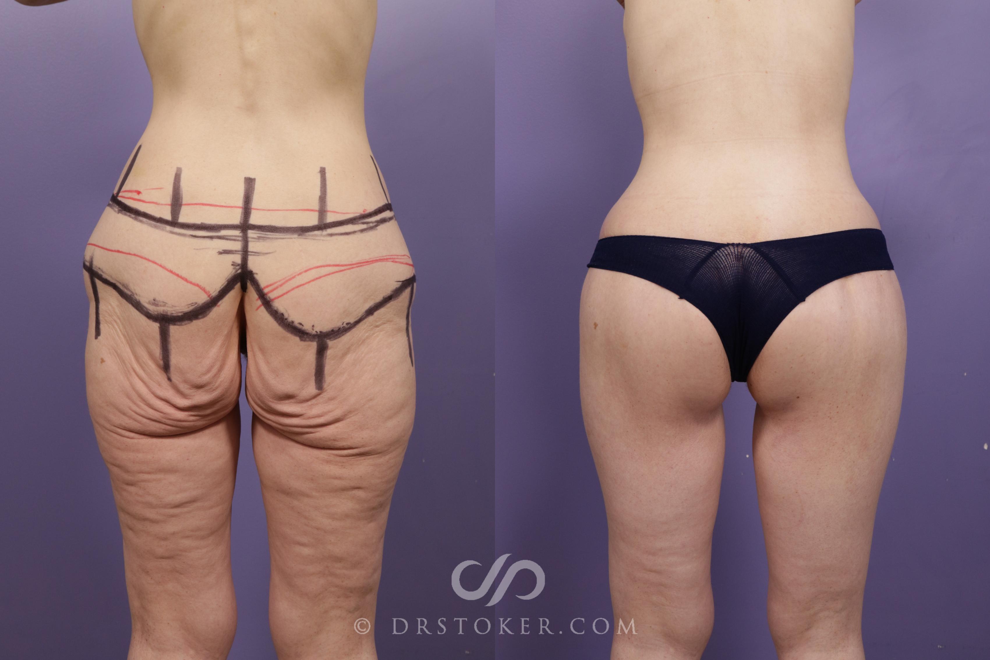 Before & After Bikini Body Lift ™ Case 2420 Back View in Los Angeles, CA