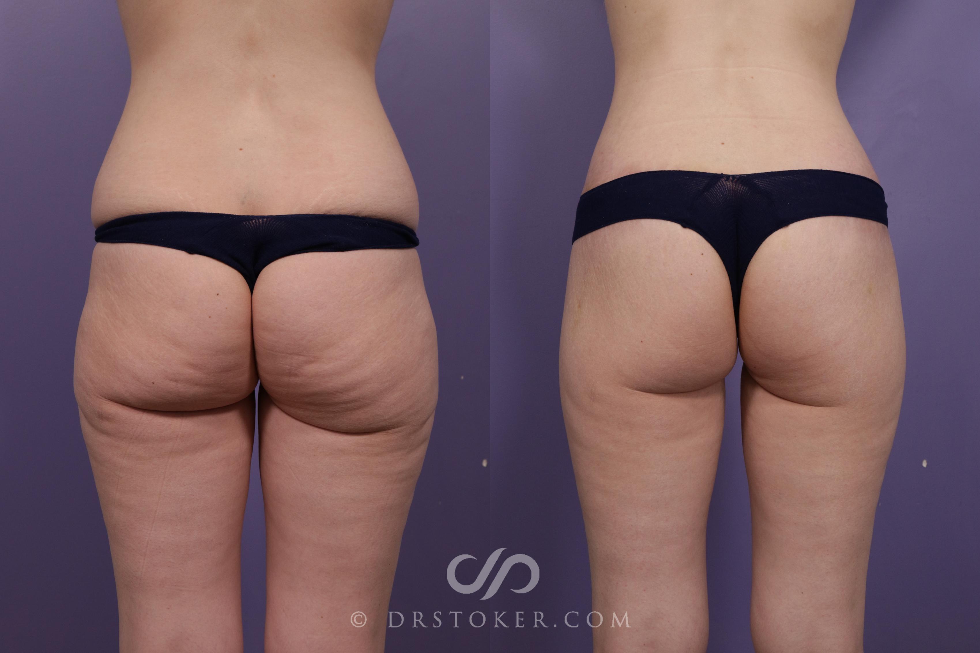 Before & After Bikini Body Lift ™ Case 2421 Back View in Los Angeles, CA