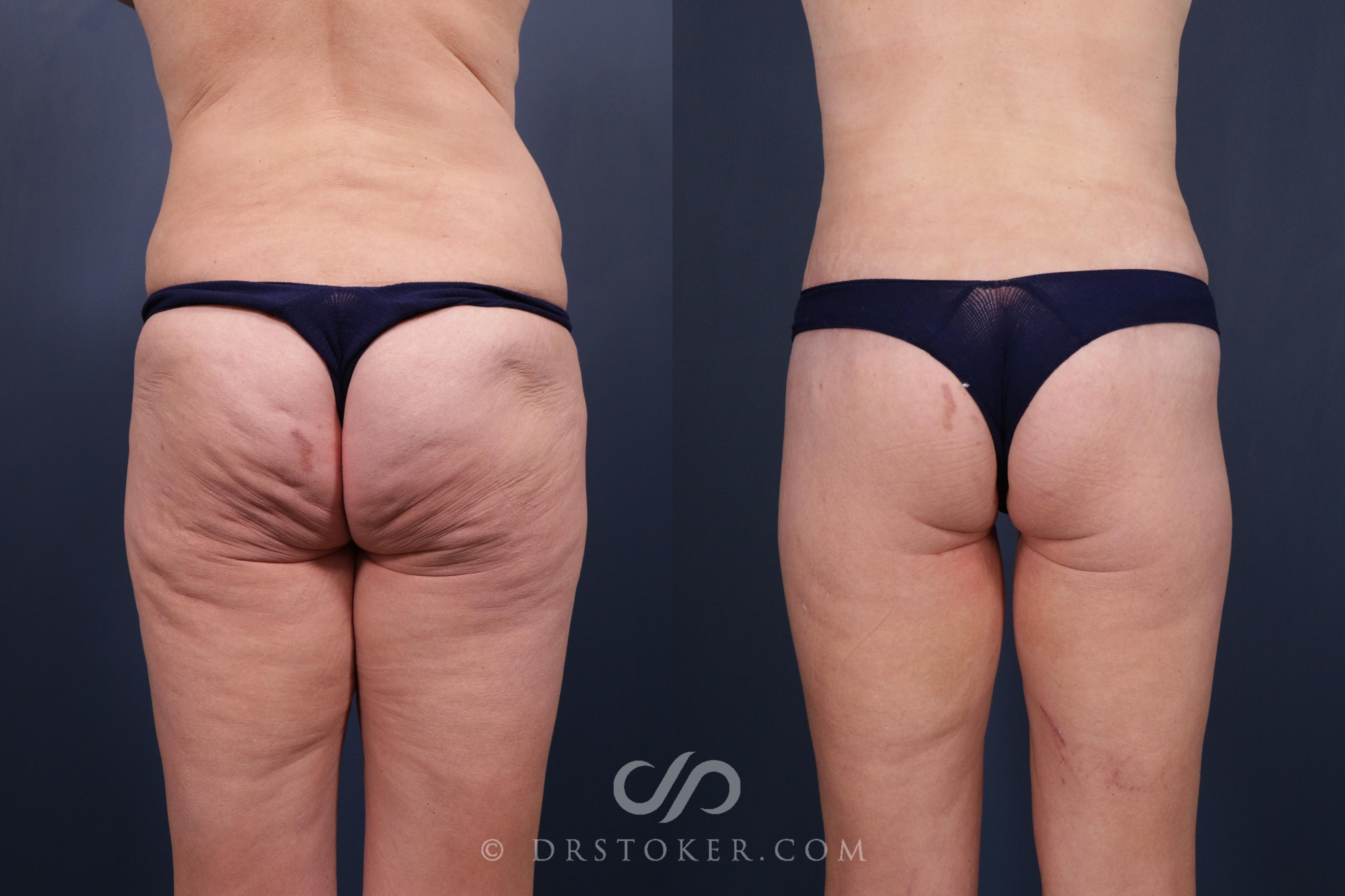 Before & After Bikini Body Lift ™ Case 2422 Back View in Los Angeles, CA