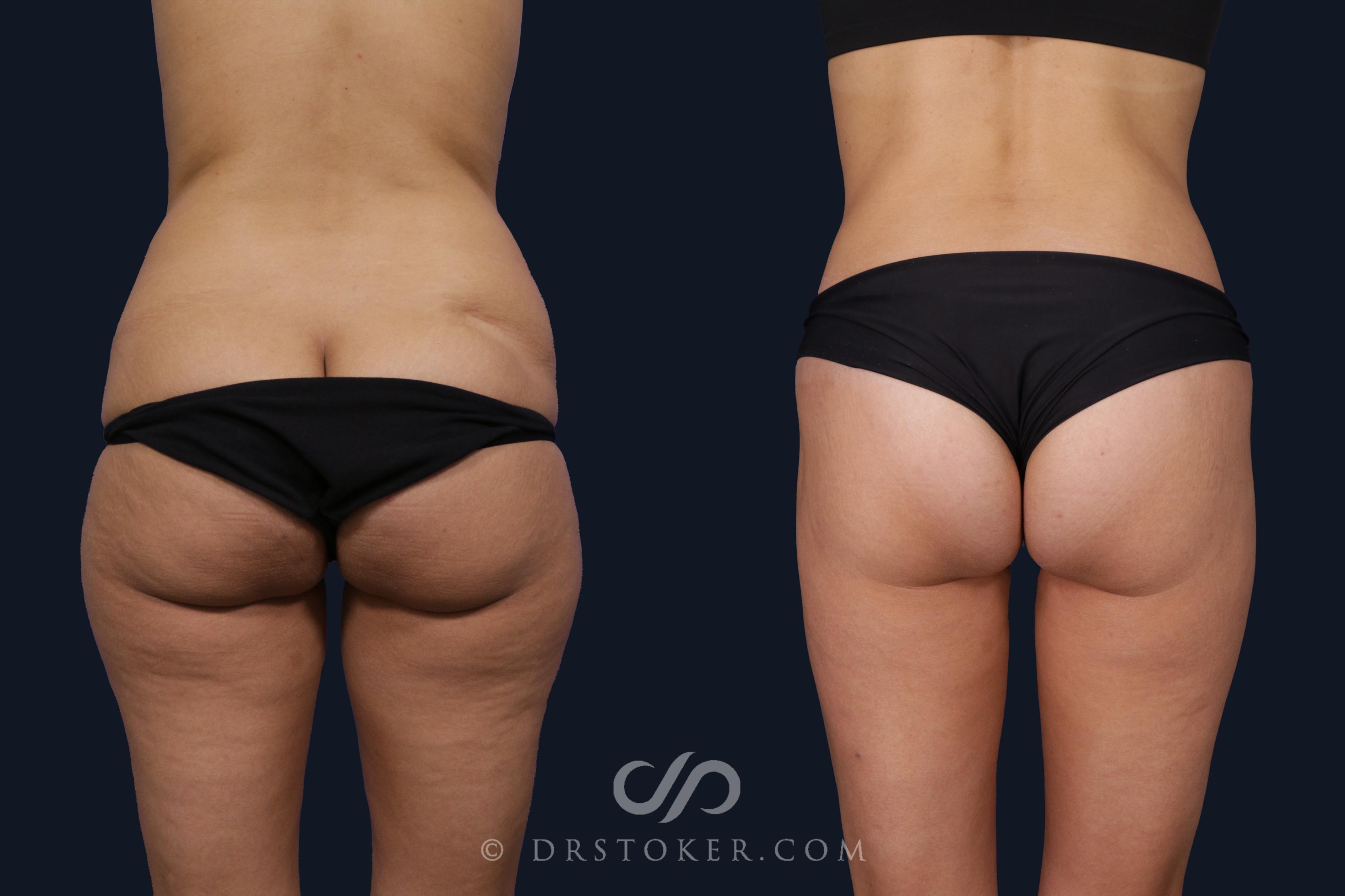 Before & After Bikini Body Lift ™ Case 2424 Back View in Los Angeles, CA