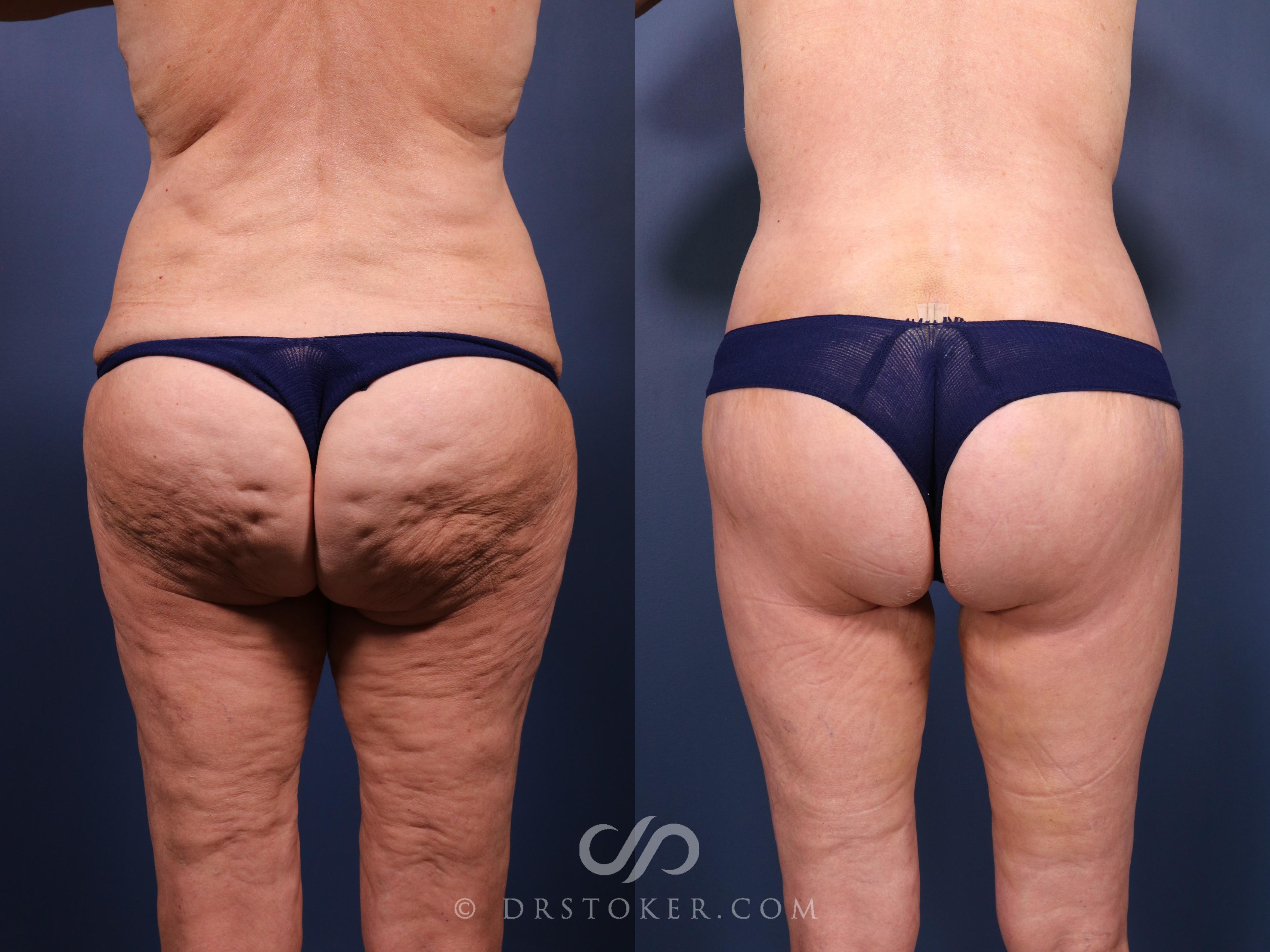 Before & After Bikini Body Lift ™ Case 2426 Back View in Los Angeles, CA