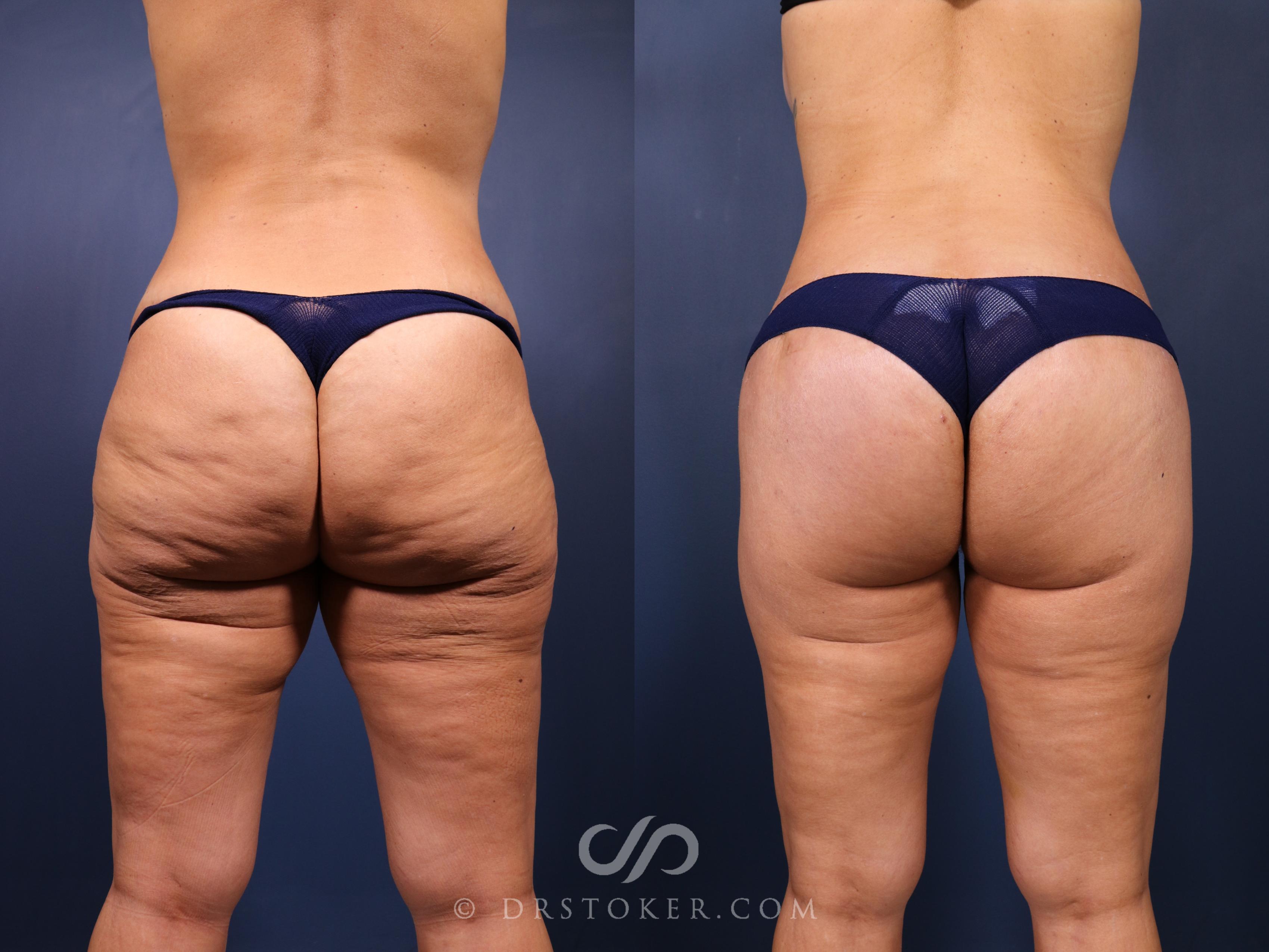 Before & After Bikini Body Lift ™ Case 2450 Back View in Los Angeles, CA