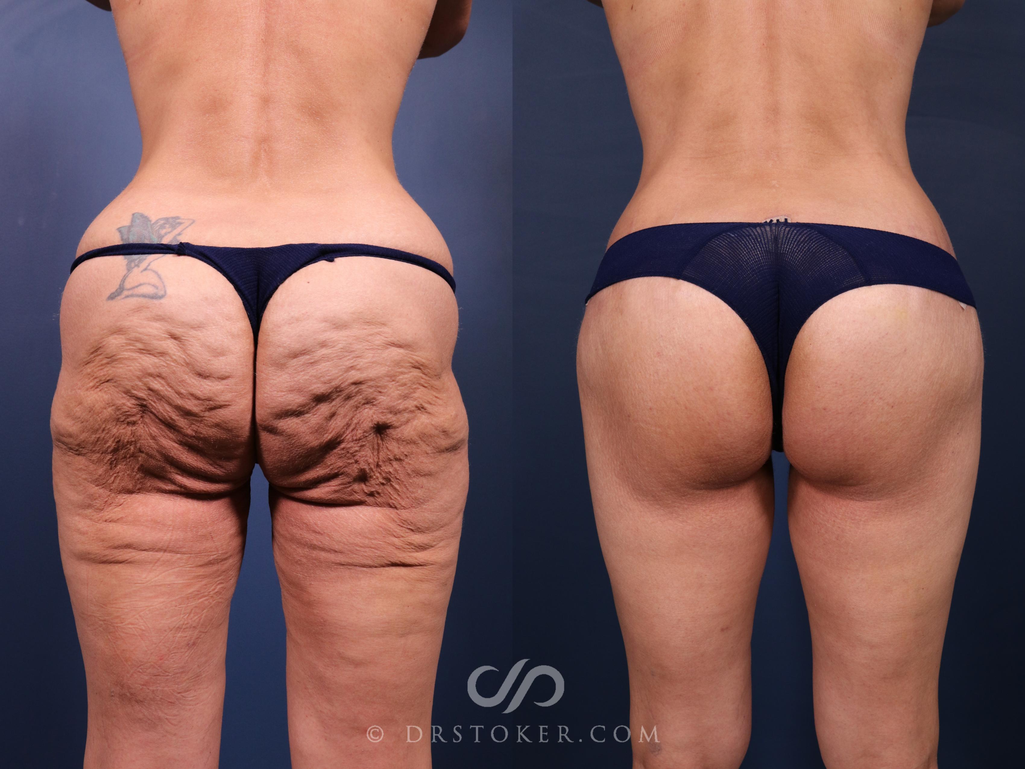 Before & After Bikini Body Lift ™ Case 2473 Back View in Los Angeles, CA