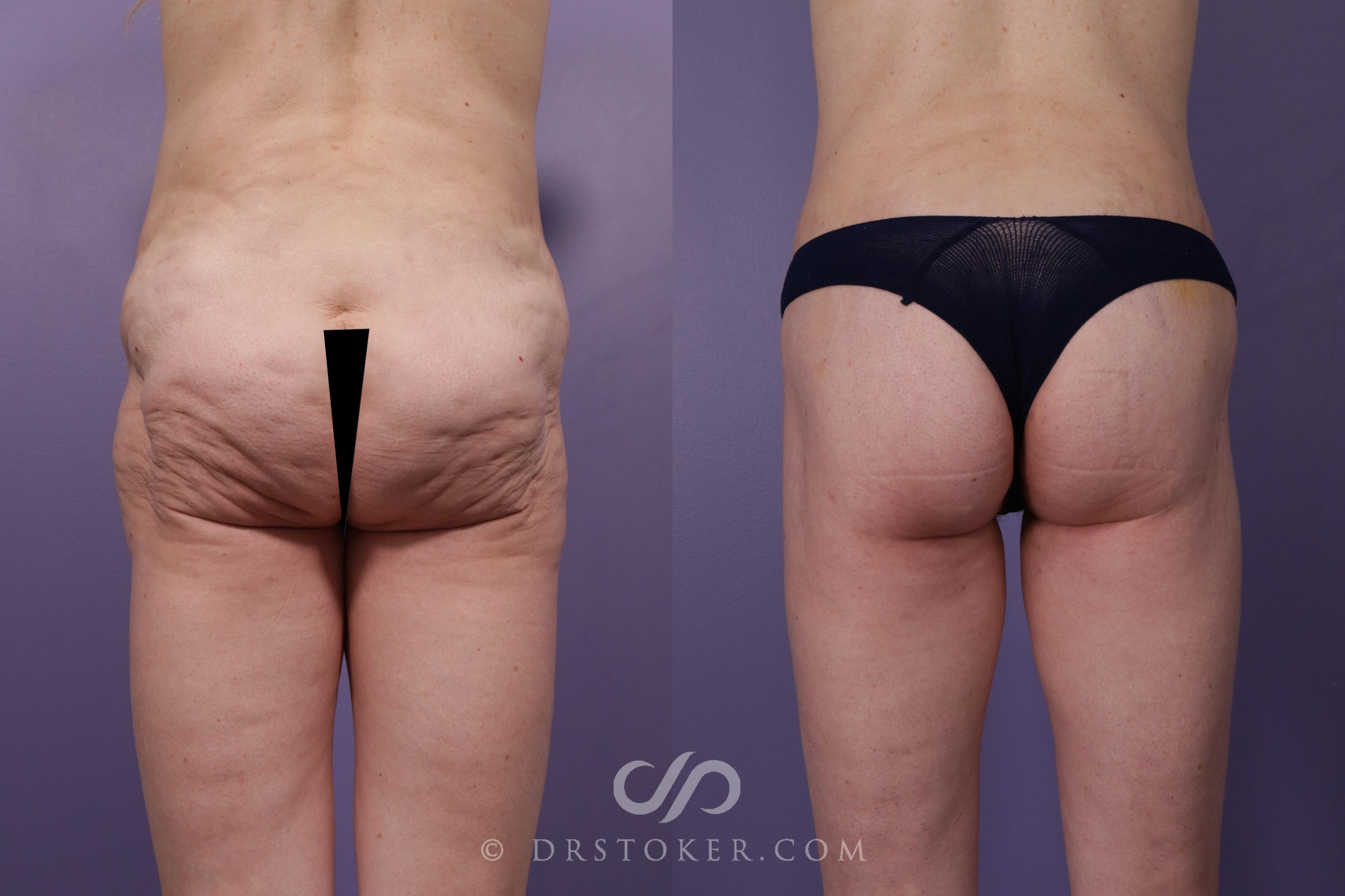 Before & After Bikini Body Lift ™ Case 2491 Back View in Los Angeles, CA