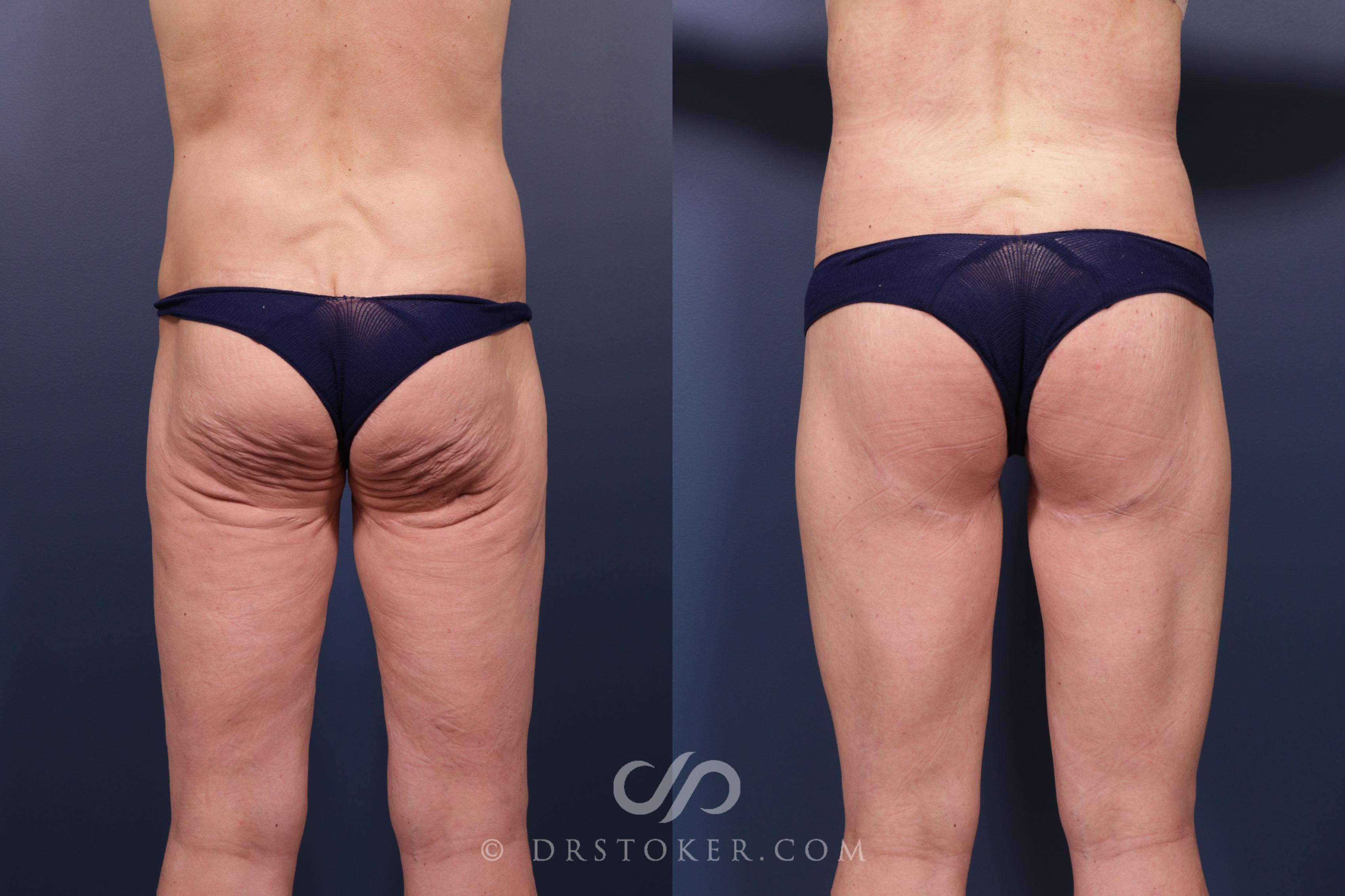 Before & After Bikini Body Lift ™ Case 2492 Back View in Los Angeles, CA