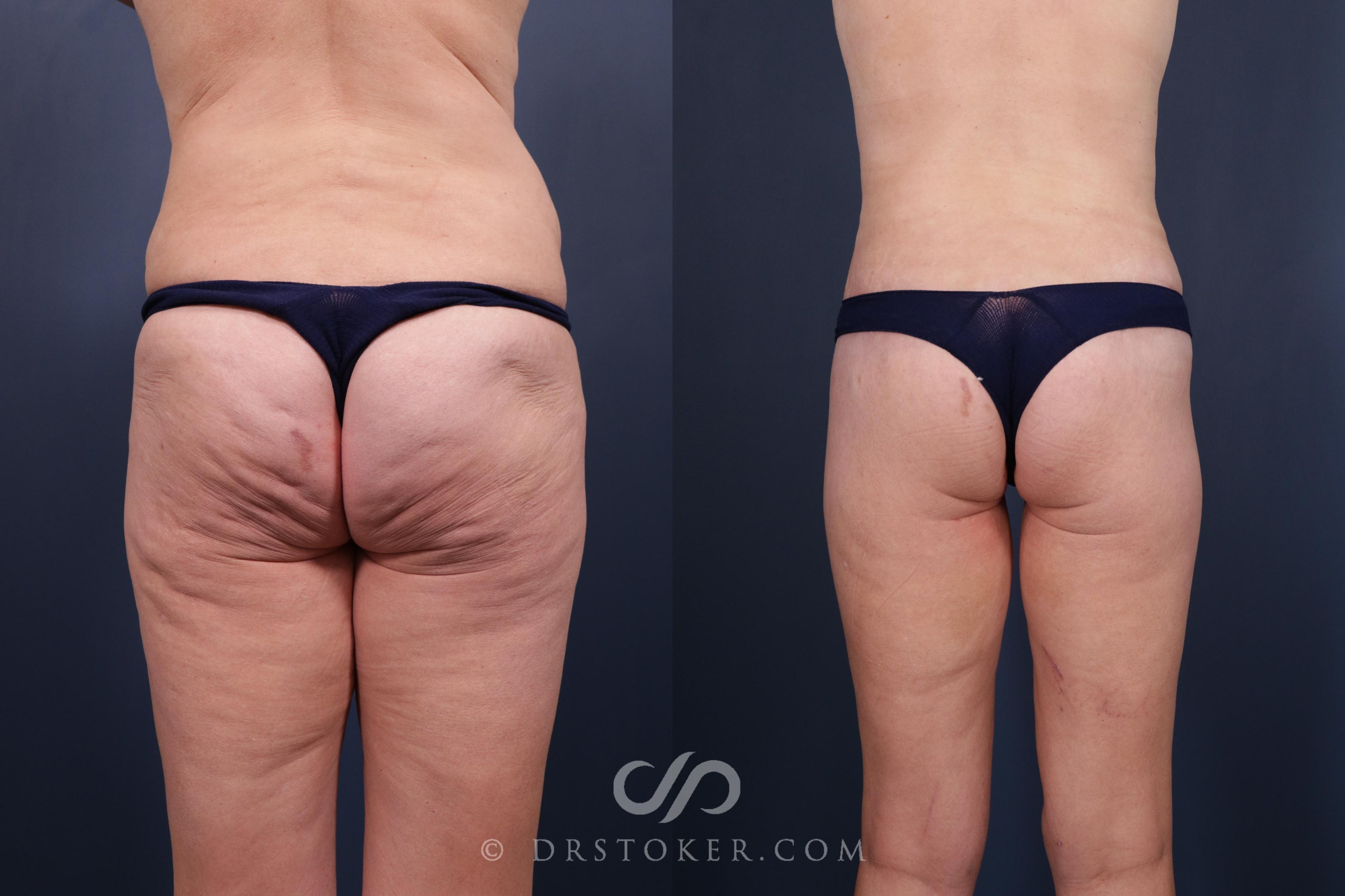 Before & After Bikini Body Lift ™ Case 2497 Back View in Los Angeles, CA