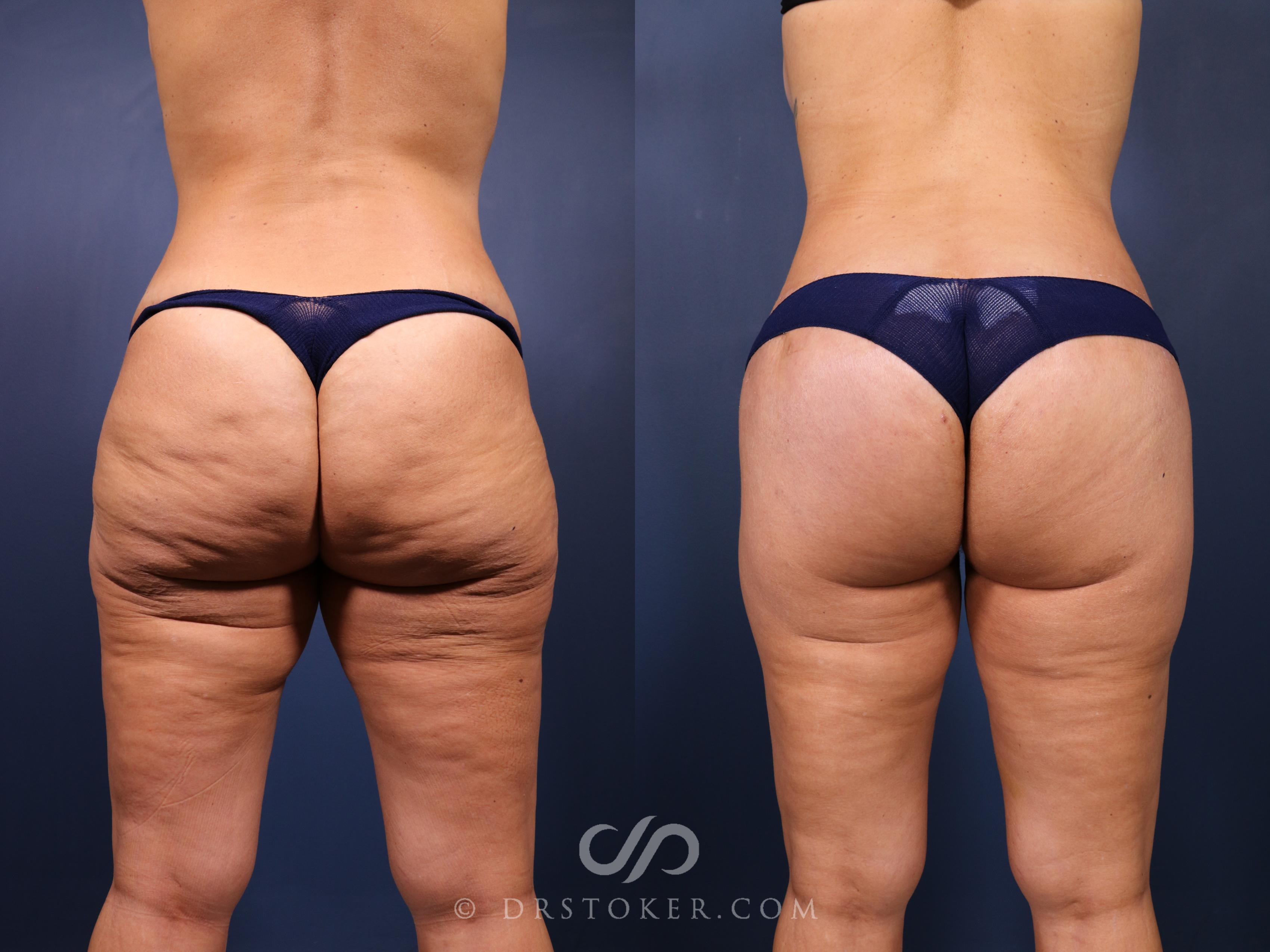 Before & After Bikini Body Lift ™ Case 2525 Back View in Los Angeles, CA