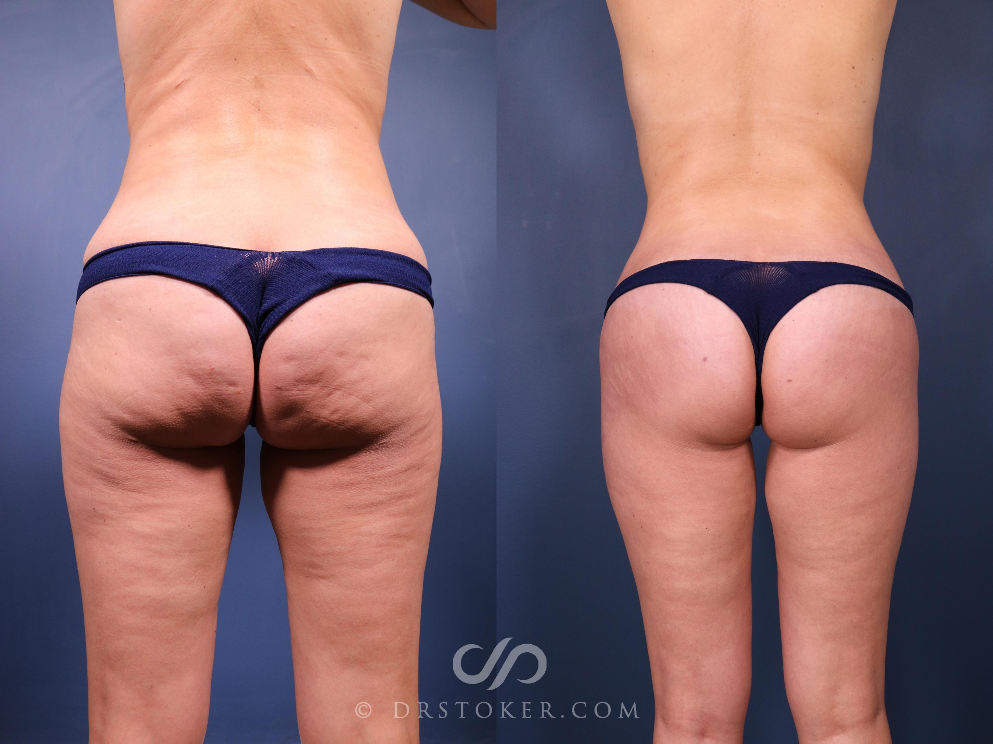 Before & After Bikini Body Lift ™ Case 2537 Back View in Los Angeles, CA