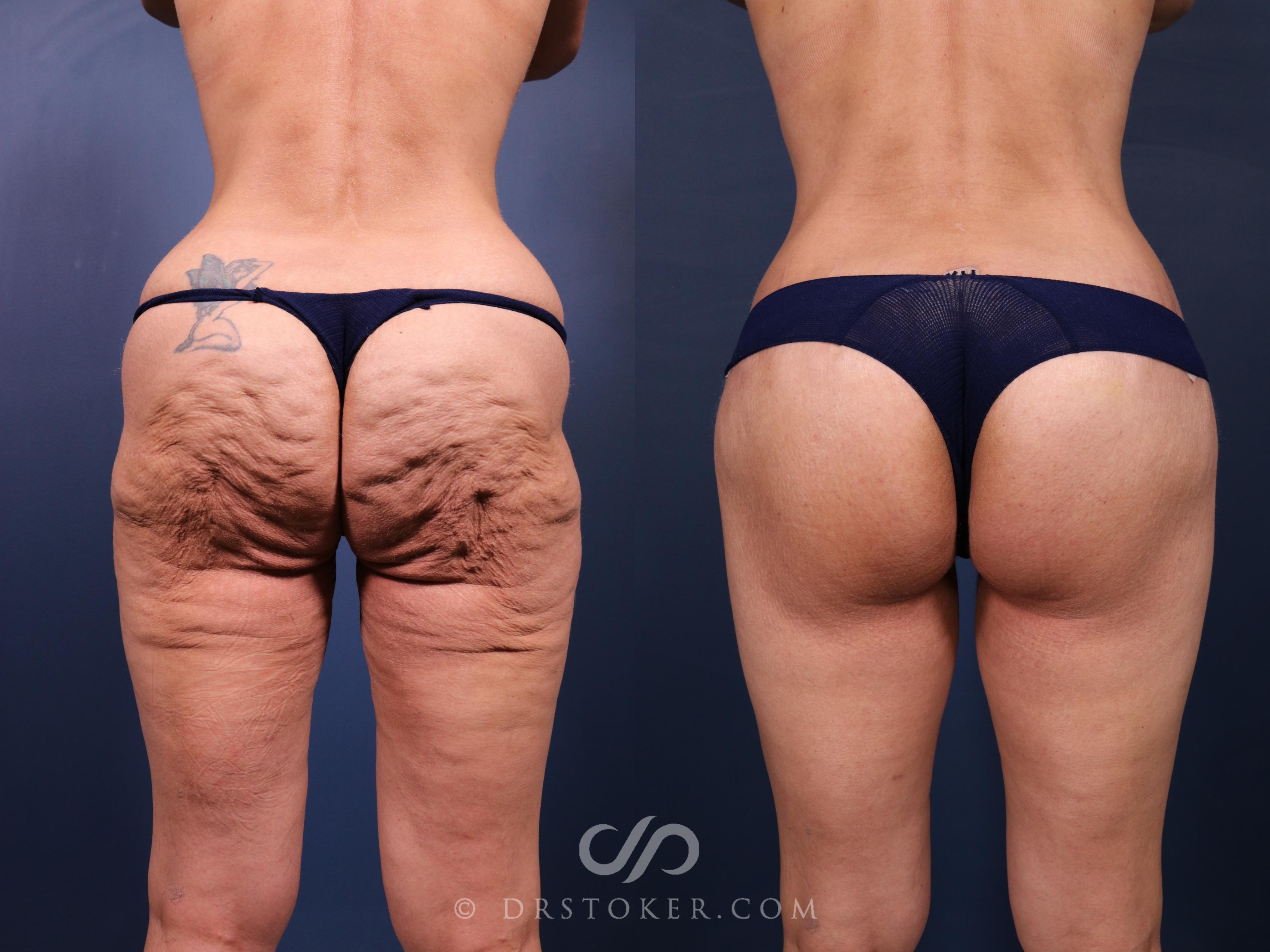 Before & After Bikini Body Lift ™ Case 2550 Back View in Los Angeles, CA