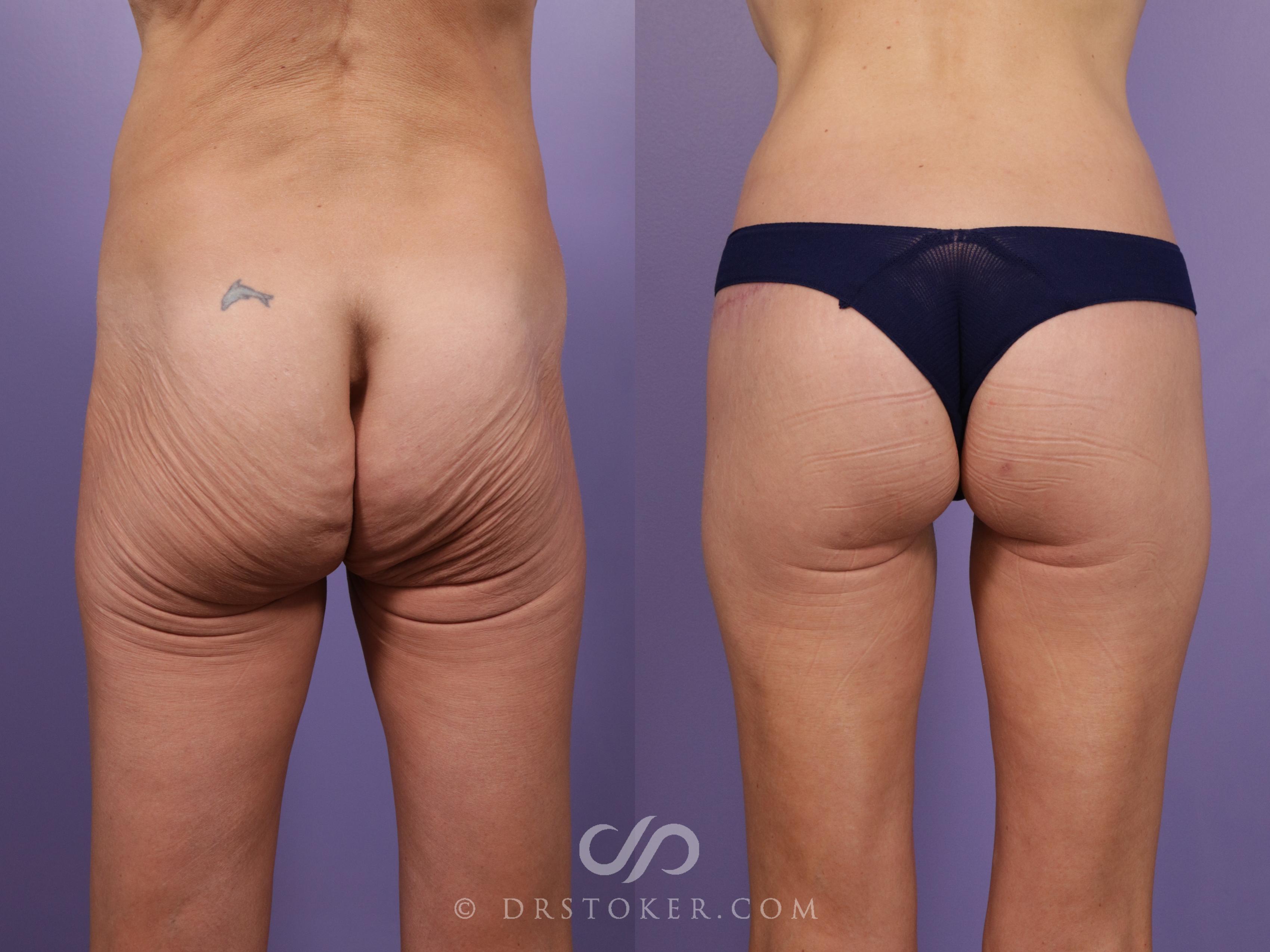 Before & After Buttock Lift (Excisional) Case 2389 Back View in Los Angeles, CA
