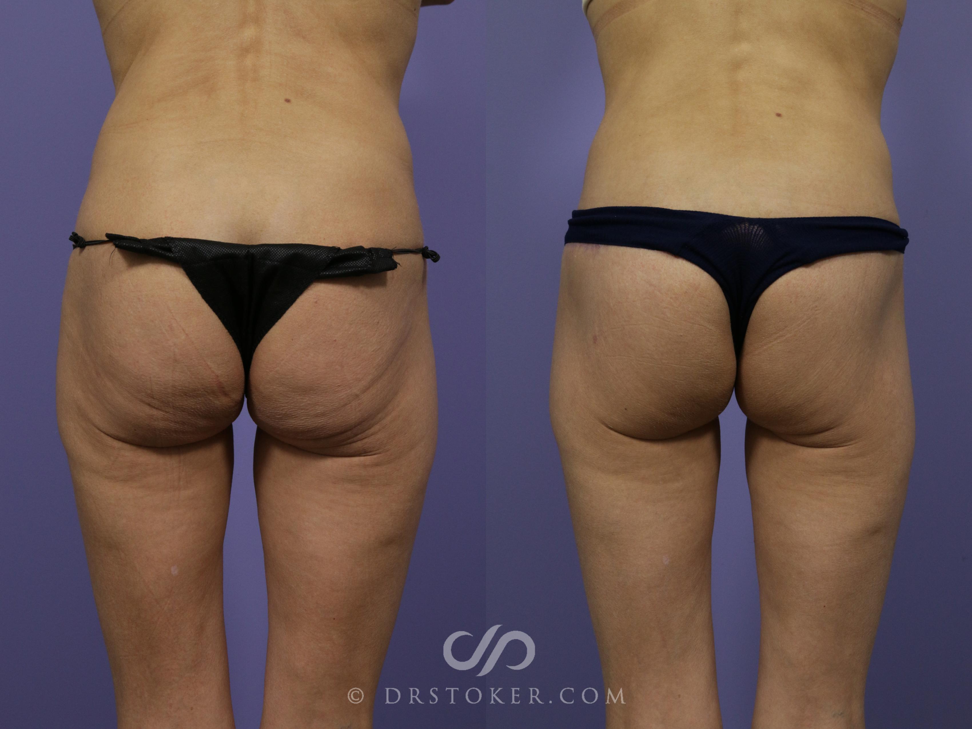 Before & After Body Lift Case 1013 View #1 View in Los Angeles, CA