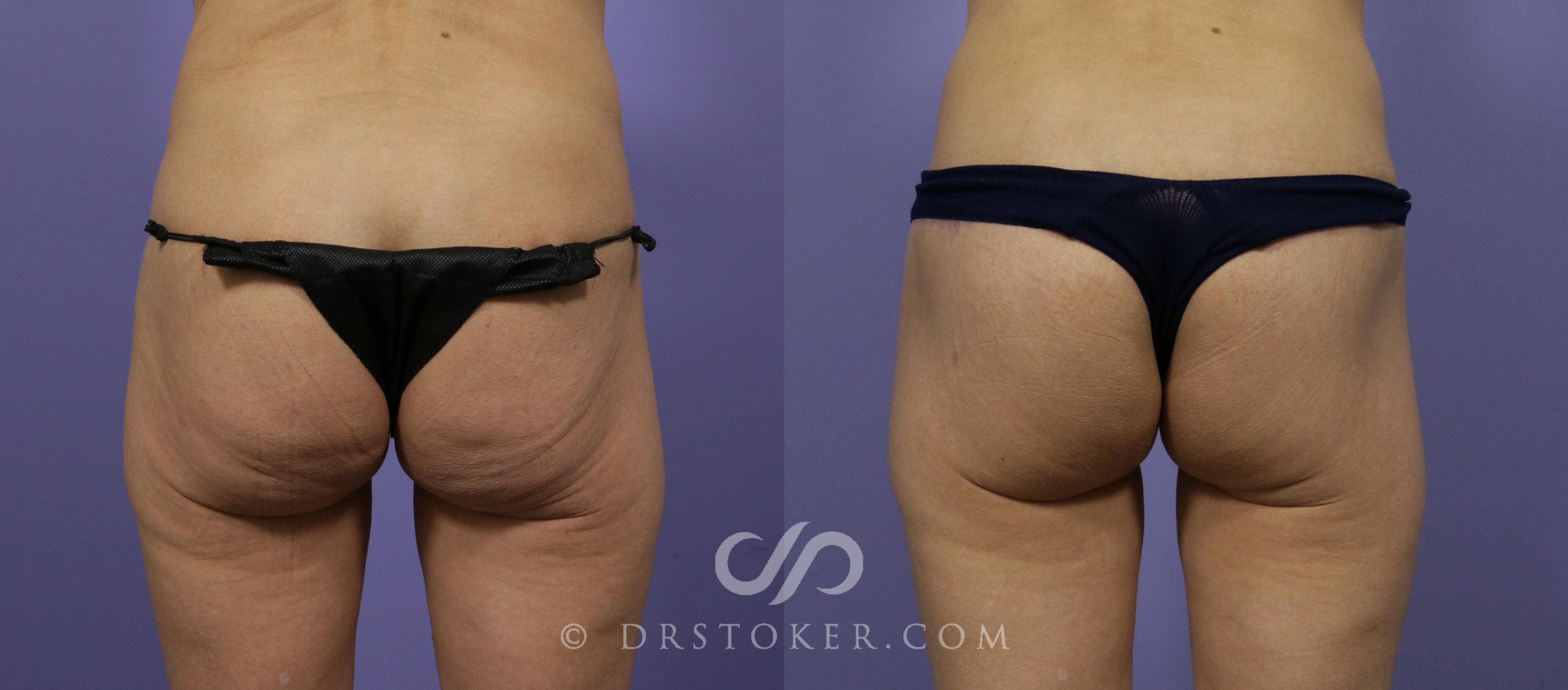 Before & After Body Lift Case 1014 View #1 View in Los Angeles, CA