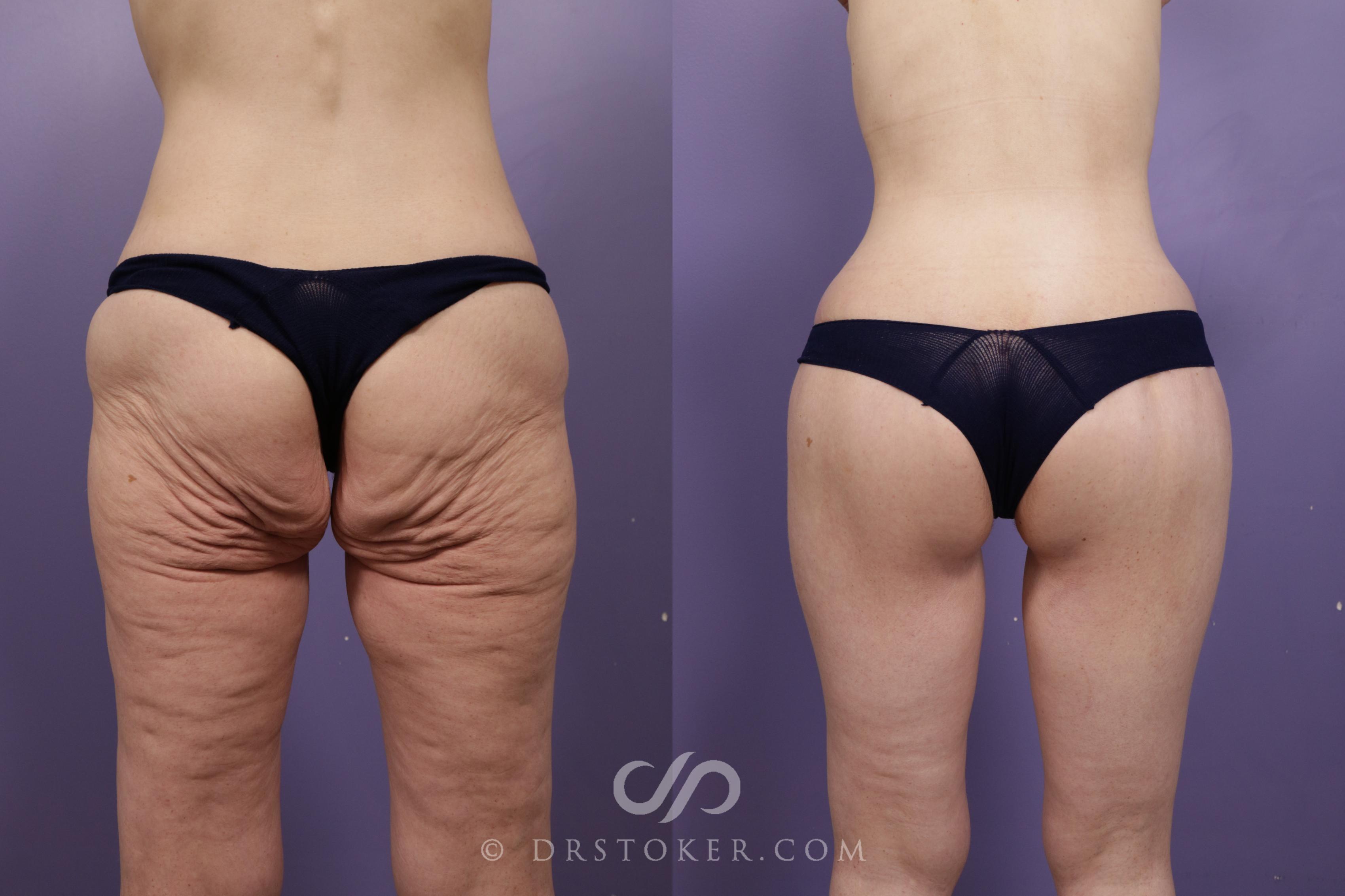 Before & After After Weight Loss Case 1676 View #1 View in Los Angeles, CA