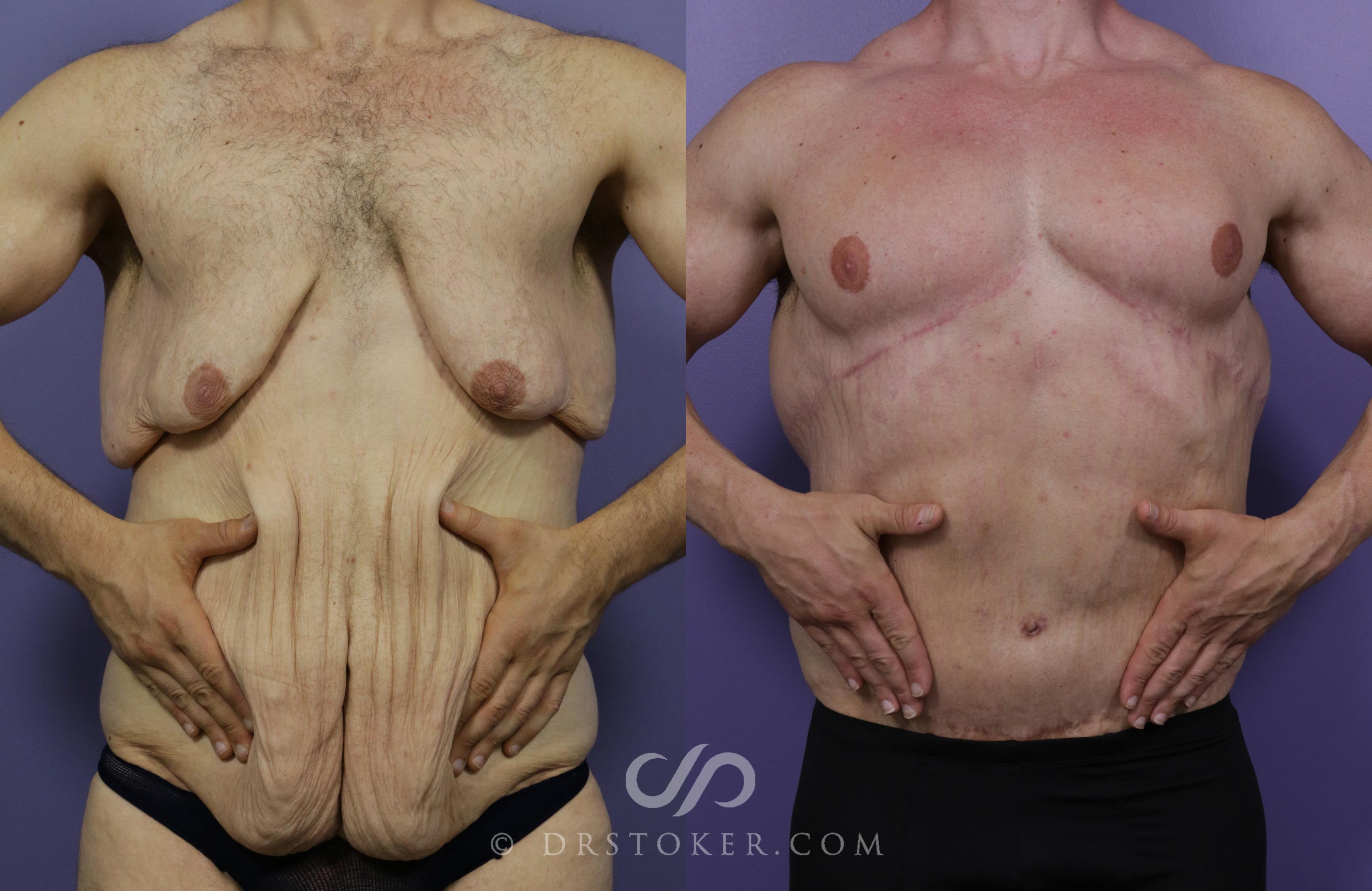 Before & After After Weight Loss Case 1714 View #1 View in Los Angeles, CA