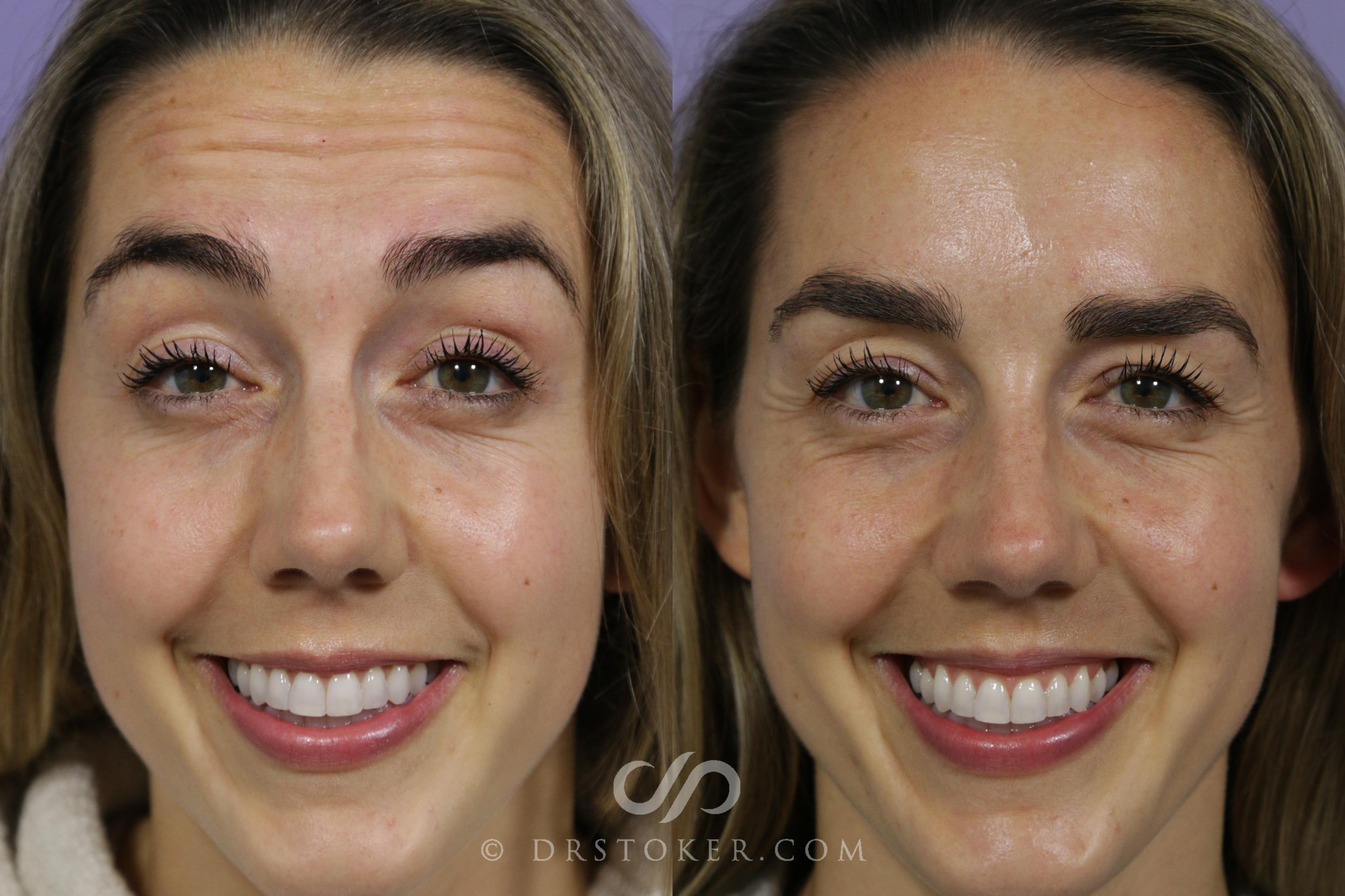 Before & After BOTOX®, Dysport®, & Jeuveau® Case 1583 View #1 View in Los Angeles, CA
