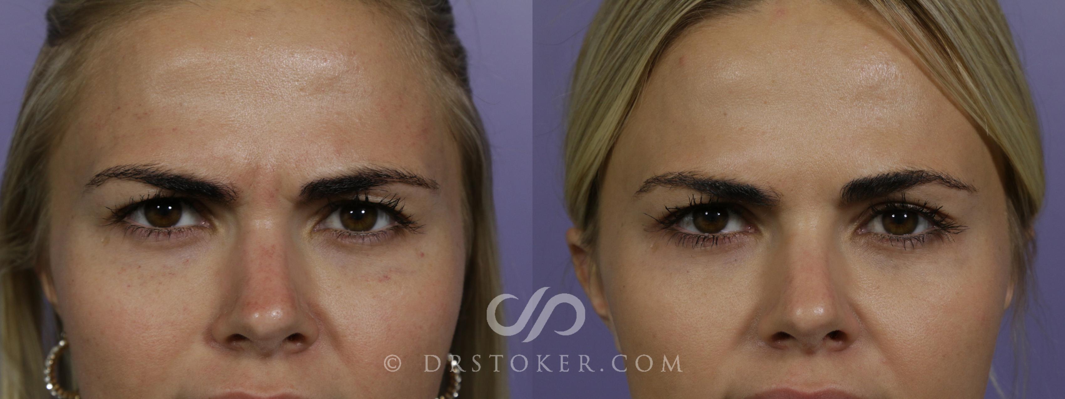 Before & After BOTOX®, Dysport®, & Jeuveau® Case 1616 View #1 View in Los Angeles, CA