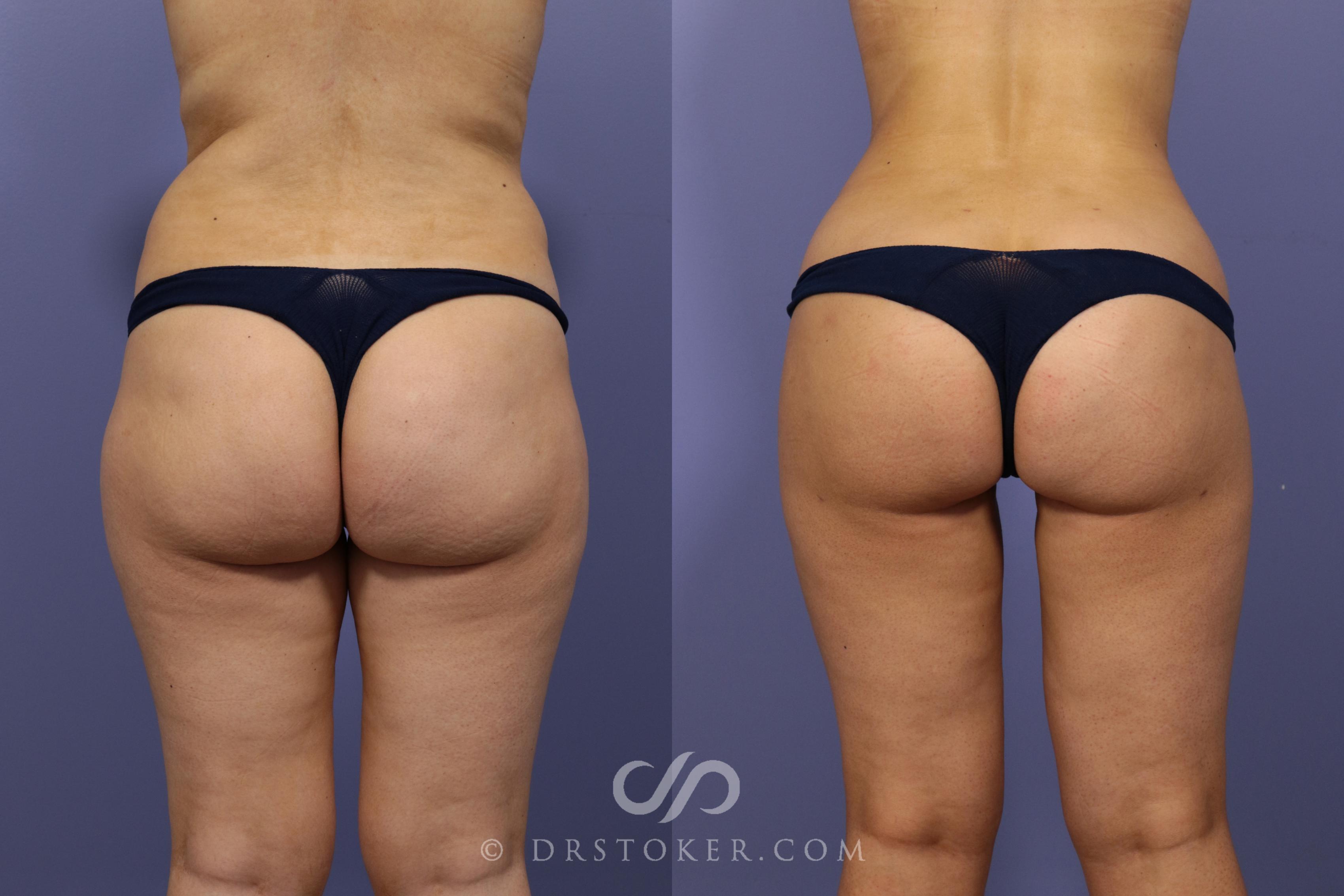 Before & After Brazilian Butt Lift (Fat Grafts to Buttocks) Case 620 View #1 View in Los Angeles, CA