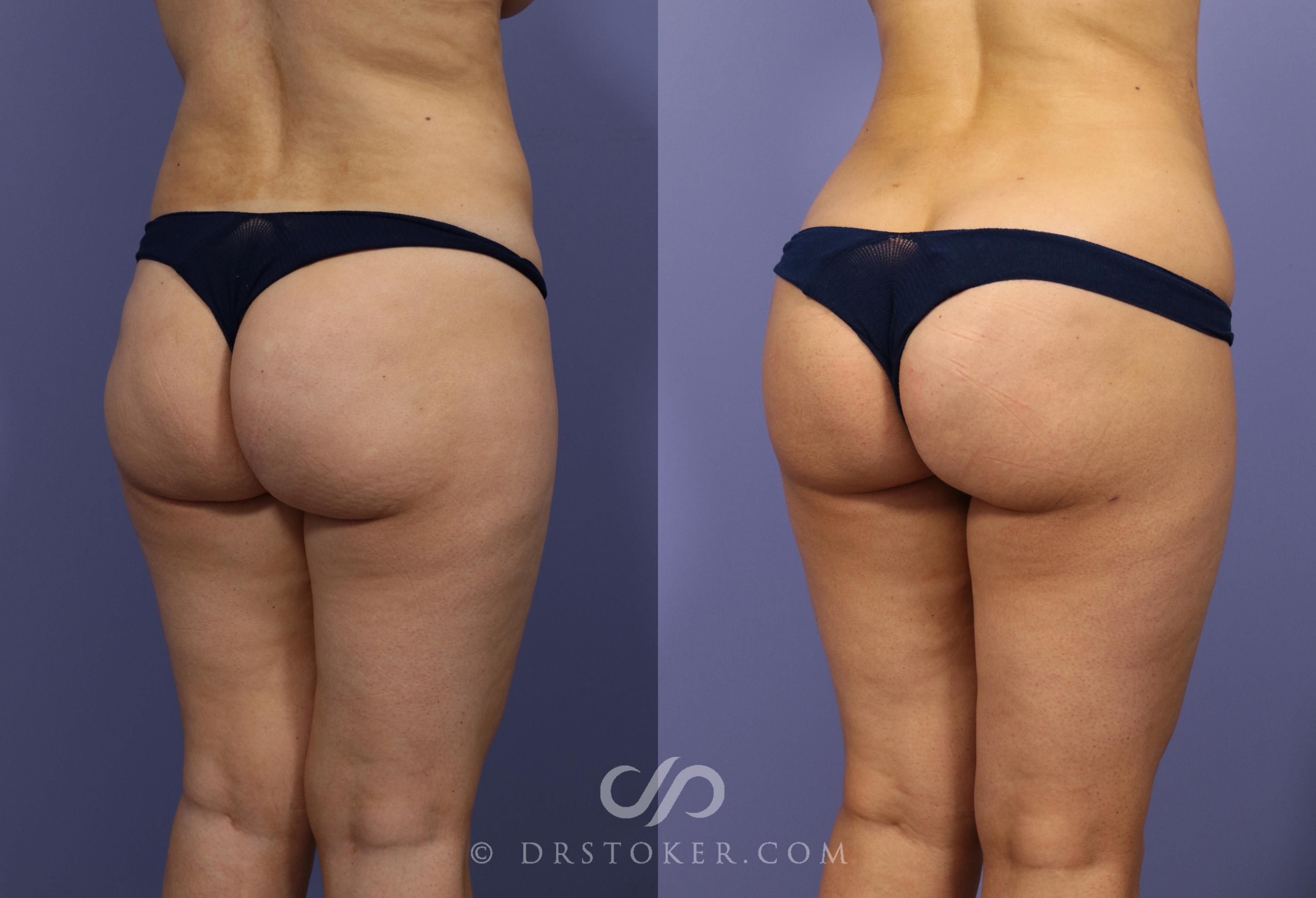 Before & After Brazilian Butt Lift (Fat Grafts to Buttocks) Case 623 View #1 View in Los Angeles, CA