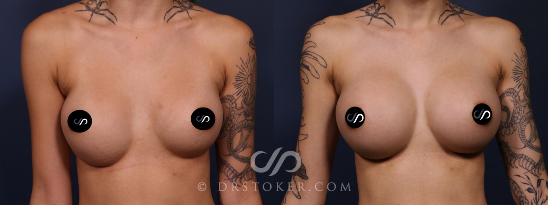 Before & After Asian Plastic Surgery Case 2625 Front View in Los Angeles, CA
