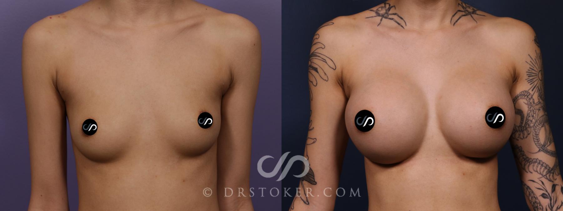 Before & After Asian Plastic Surgery Case 2626 Front View in Los Angeles, CA