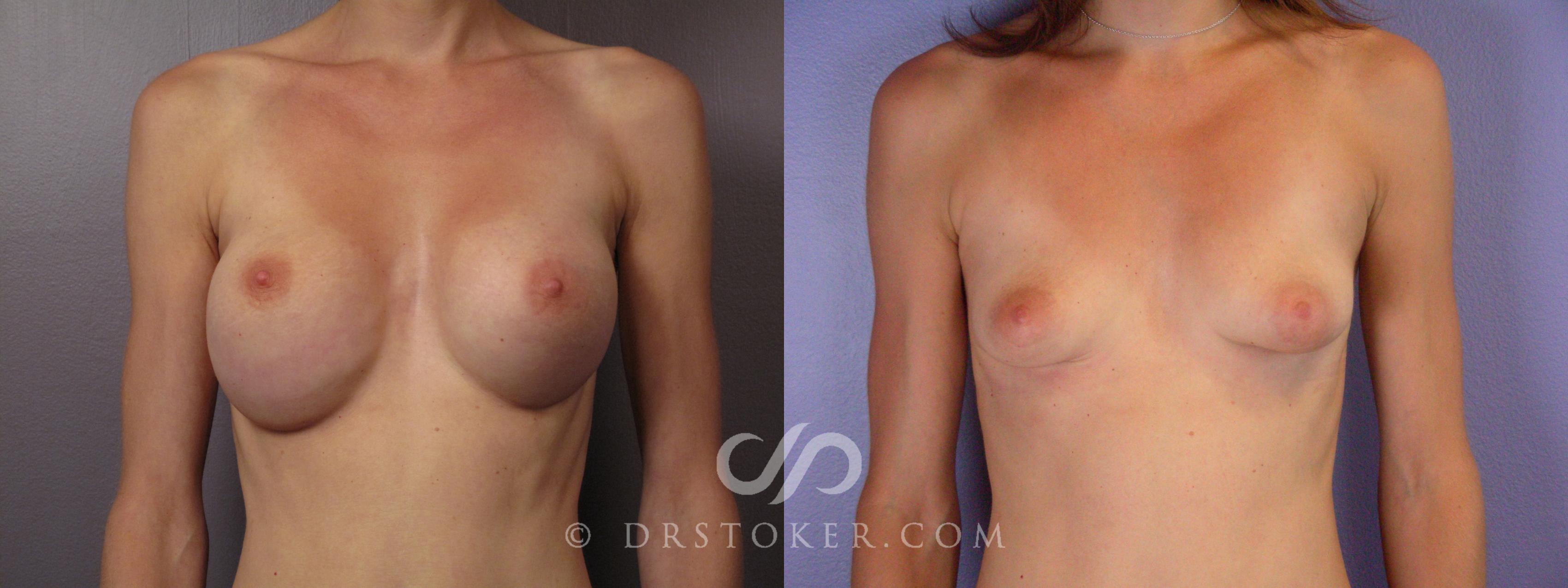 Before & After Breast Implant Removal Case 377 View #1 View in Los Angeles, CA