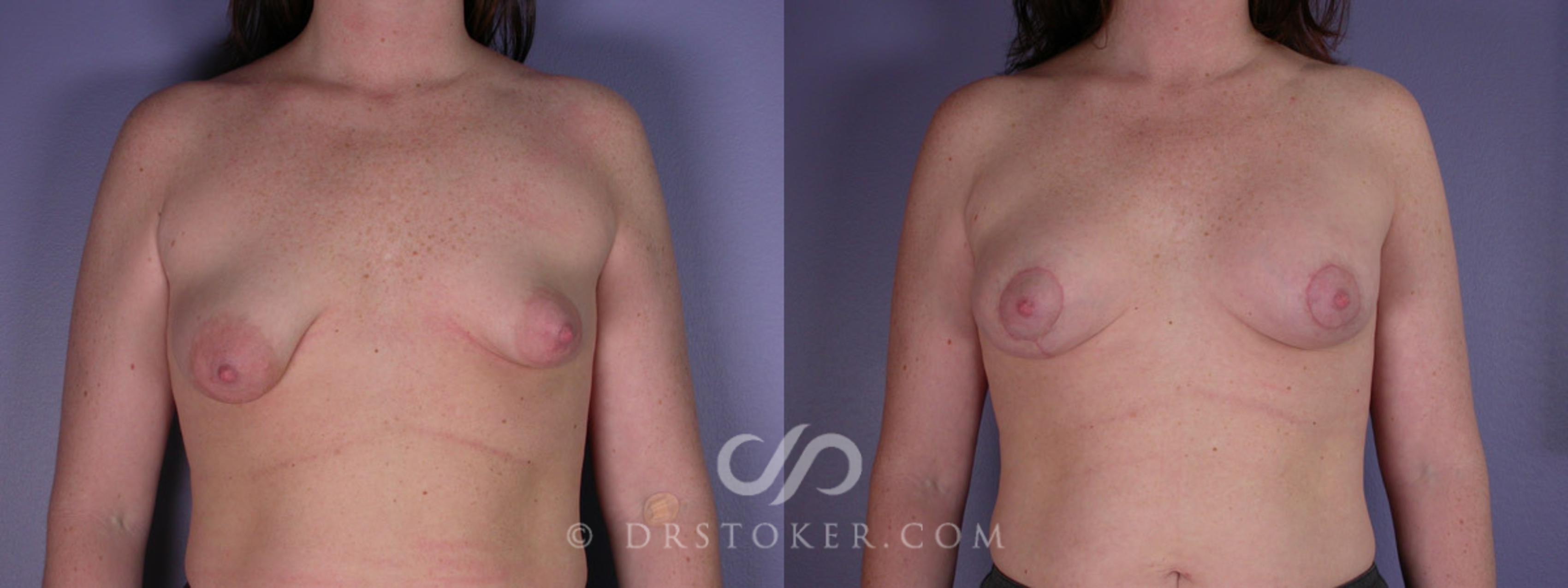 Before & After Breast Augmentation with Lift Case 193 View #1 View in Los Angeles, CA