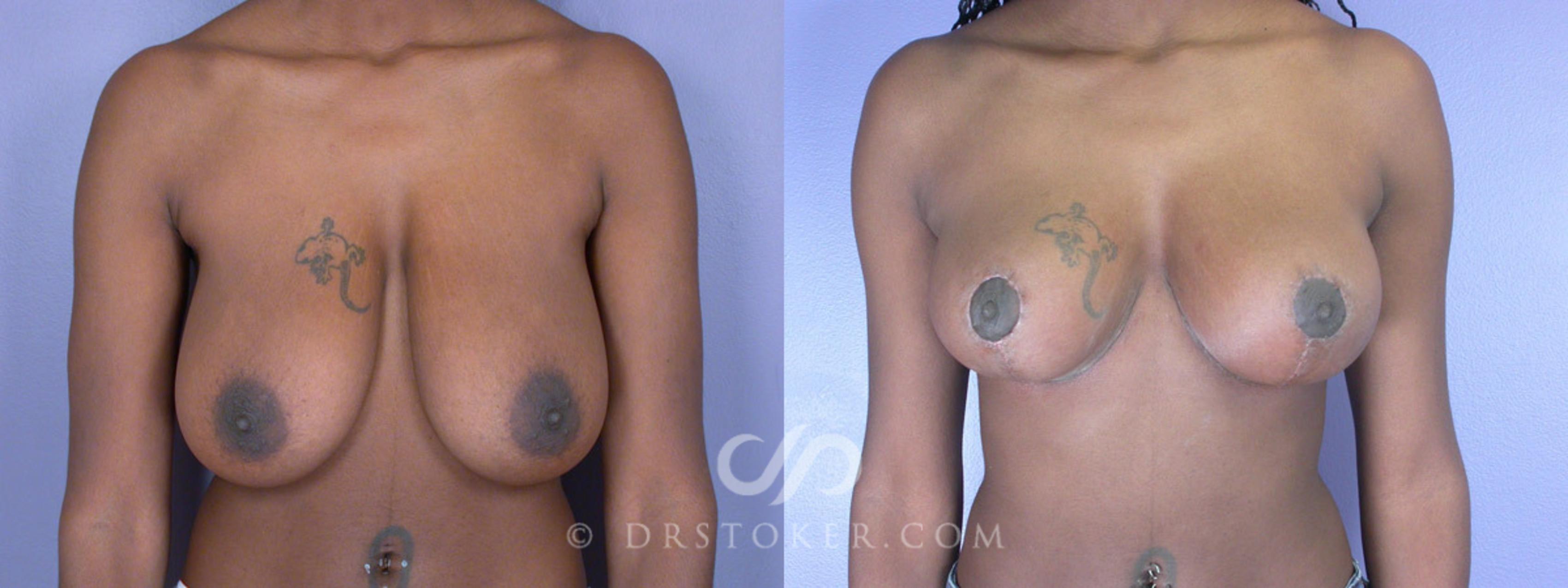Before & After Breast Reduction (for Women) Case 197 View #1 View in Los Angeles, CA